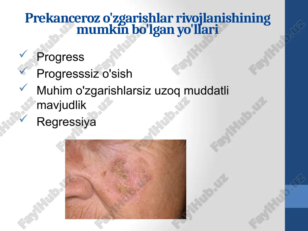 an - tuprik bezlarining bo'shliq kanallariga aylanadi. 17 leykoplakiyaning differentsial diagnostikasi tashxis gistologik tekshiruv natijalari bilan shubhali holatlarda tasdiqlangan klinik ma'lumotlarga asoslanadi. leykoplakiya shunga o'xshash: liken planus qizil eritematoz sifilitik papulalar engil leykoplakiya kandidozning ba'zi shakllari 18 davolash verrukoz va eroziv shakllarda: keng ko'lamli eksizyon (bu afzalroq) yoki lazer yordamida yo'q qilish, kriyodestruksiya. yassi shaklida: ichkarida - aevit, piridoksin (piridoksal fosfat) terapevtik dozalarda, 1-1,5 oygacha bo'lgan kurslar, tashqi tomondan - a vitamini, 10% liniment dibunolning yog'li eritmasi. leykoplakiyaning verrukoz va eroziv shakllari maligizatsiya ehtimoli yuqori bo'lgan ixtiyoriy prekanserlardir. bilish muhimdir 19 bemorlarni boshqarishning umumiy tamoyillari chekishni taqiqlash og'iz bo'shlig'ini sanitariya qilish (barcha shikast va bezovta qiluvchi omillarni yo'q qilish, oqilona protezlash) oshqozon-ichak trakti patologiyasini davolash. dudoqlarning qizil chegarasini izolyatsiyadan himoya qilish (fotoprotektiv malhamlar) dispanser kuzatuvi bashorat: radikal davolashsiz, ayniqsa, og'izning pastki qismida, tilning pastki qismida joylashgan bo'lsa, malignite mumkin; davolashdan keyin prognoz yaxshi 20 lichen planus lichen planus - bu …