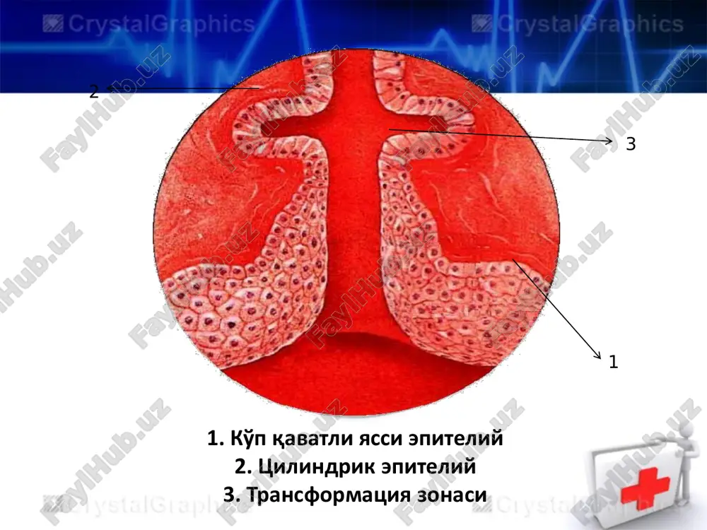 va kuzatish usuli xisoblanadi. tekshiruv natijalarini surat yoki rasm kurinishida uzok muddat saklash imkonini beradi.odatda xar kanday tibbiy muassasada shifokor tomonidan amalga oshirish mumkin. kolposkopiya oddiy kengaytirilgan kolposkopiya ektopiya leykoplakiya endometrioz polip kolposkopiya endometrioz polip ektropion nabotova kista kolposkopiya yalliglanishli uzgarish. atipik uzgarish. yukori onkogen virus shtamlarini tashxislash. digene hpv test – opvning dnk-sining spetsifik (uziga xos) fragmentlarini aniklashga yunaltirilgan molekulyar texnologik usul. 2008 yil bachadon buyni saratonini kelib chikishida opv axamiyati va rolini aniklagan olimlar guruxi nobel mukofoti bilan takdirlanganlar. pap test pap test – skrining natija. belgilari rasm ascus norma xam emas, atipiya xam emas. asc-h norma xam emas, lekin atipiyani ba'zi belgilari bor. lsil atipiya, past darajadagi shikastlanish belgilari. hsil atipiya, yukori darajadagi shikastlanish belgilari. bachadon bo'yni saratoni profilaktikasi. bjsst 25 yoshdan boshlab ketma-ket 2 yil,keyin doimiy ravishda xar 3 yilda 1marotaba tsitologik skrining utkazishni tavsiya etadi. bachadon bo'yni saratoni profilaktikasi tsitologik skriningi. tsitologik tekshiruvga surtma olish …