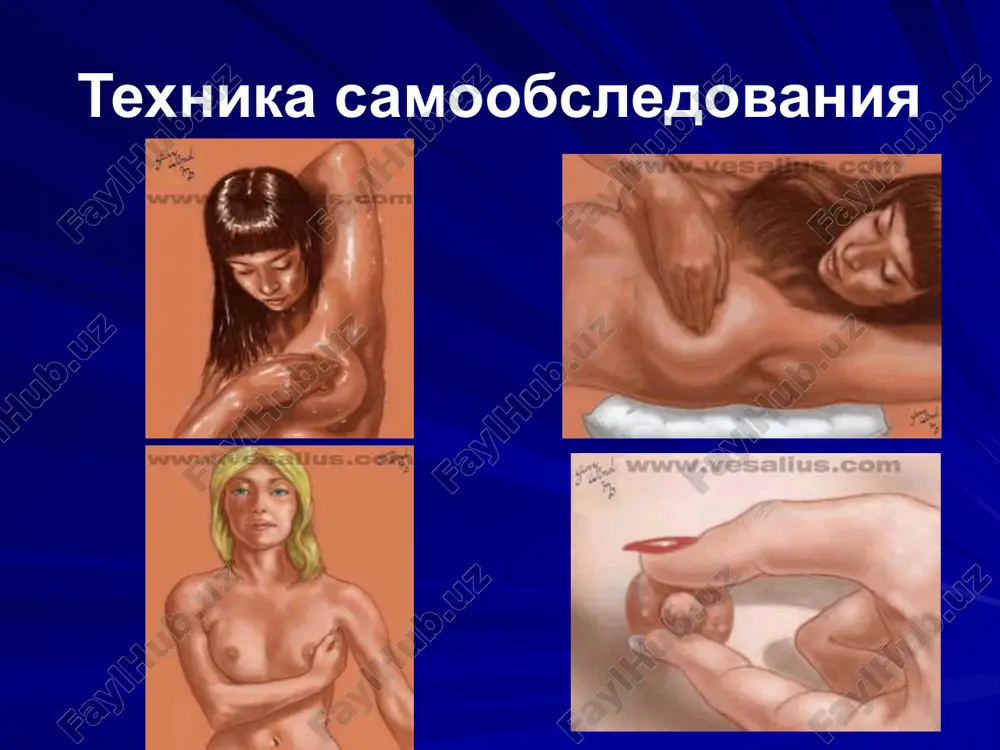 gormonalnoy giperplazii molochnix jelez. pervichnoe besplodie. pervie rodi v bolee zrelom vozraste (26 let i starshe). pozdnee nachalo menstruatsiy (17 let i starshe). pozdnee nastuplenie menopauzi. neregulyarnost i pozdnee nachalo polovoy jizni (30 let i starshe), primenenie sredstv predoxraneniya (ximicheskie, mexanicheskie). ponijennoe libido, frigidnost. prodoljitelniy period kormleniya detey grudyu (laktatsiya bolee 1-2 let). rojdenie krupnix detey (massa tela 4000 i bolee). povishennaya massa tela jenshin (70 kg i bolee). estrogennaya nasishennost organizma pojilix jenshin pri dlitelnosti menopauzi 10 let i bolee (iii i iv reaktsiya vaginalnogo mazka). uvelichenie shitovidnoy jelezi. visokaya zabolevaemost zlokachestvennimi opuxolyami sredi rodstvennikov po materinskoy linii. perenesenniy poslerodoviy mastit, osobenno lechenniy konservativno. travmi molochnoy jelezi. stepen riska raka mj v zavisimosti ot vozrasta mejdunarodnaya klinicheskaya klassifikatsiya raka molochnoy jelezi (tnm) gistologicheskaya klassifikatsiya raka molochnoy jelezi: neinfiltriruyushaya kartsinoma: vnutriprotokoviy rak; dolkoviy rak infiltriruyushaya kartsinoma: vnutriprotokoviy rak; dolkoviy rak osobie gistologicheskie varianti: bolezn pedjeta kartsinoma, voznikayushaya iz kletochnoy vnutriprotokovoy …