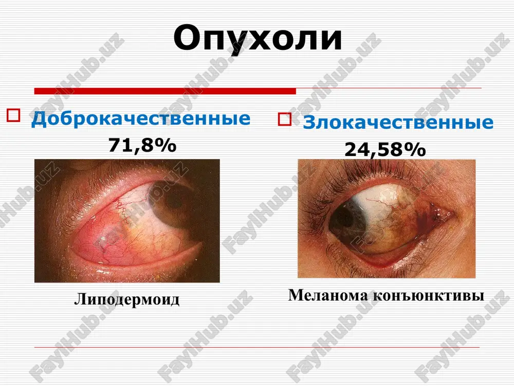 rvichnie razdelyayutsya na opuxoli sosudistogo trakta i setchatki. vnutriglaznie novoobrazovaniya (sosudistoy obolochki, setchatki i diska zritelnogo nerva) dobrokachestvennie opuxoli neyrofibromi nevusi angiomi kisti gemangioma astrotsitoma zlokachestvennie opuxoli retinoblastoma melanoma opuxoli resnichnogo tela i radujki mejdunarodnaya klassifikatsiya po sisteme tnm t — pervichnaya opuxol: tx — nedostatochno dannix dlya otsenki pervichnoy opuxoli, t0 — pervichnaya opuxol ne opredelyaetsya. radujnaya obolochka: t1 — opuxol ogranichena radujnoy obolochkoy, t2 — opuxol porajaet ne bolee odnogo kvadranta i rasprostranyaetsya na ugol peredney kameri, t3 — opuxol porajaet bolee odnogo kvadranta i rasprostranyaetsya na ugol peredney kameri, resnichnoe telo i/ili sobstvenno sosudistuyu obolochku, t4 — opuxol rasprostranyaetsya za predeli glaza. resnichnoe telo: t1 — opuxol ogranichena resnichnim telom, t2 — opuxol rasprostranyaetsya na perednyuyu kameru i/ili radujnuyu obolochku, tz — opuxol rasprostranyaetsya na sobstvenno sosudistuyu obolochku, t4 — opuxol rasprostranyaetsya za predeli glaza. opuxoli xorioidei mejdunarodnaya klassifikatsiya po sisteme tnm t1 — opuxol razmerami do …