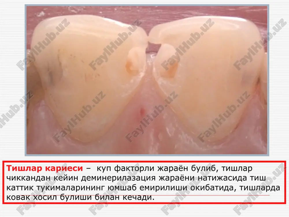 liferativ 3) proliferativ gipertrok 4) gangrenoz g. sut va doimiy tishlar surunkali pulpitlarning utkirlashuvi bolalarda utkir pulpitlar kechishining uziga xos xususiyatlari. uchokli pulpit kiska muddat kechadi yalliglanish jarayoni tez tarkalib toj pulpasidan ildiz pulpasiga utadi yalliglanishg tezda yiringliga utadi klinik kechishining rang-barangligi utkir pulpit tezda surunkali shaklga utishi, tukima nekrozi organizmning umumiy zaxarlanishi bilan kechadi ildizlari rivojlanmagan sut tishlaridagi utkir uchokli pulpit utkir uchokli pulpit utkir seroz umumiy pulpit surunkali pulpitlar uchun proliferatsiya jarayonlari dumalok xujayralar infiltratsiyasi ustuvor buladi. shishlar yukolib, tolali elementlar va odontoblastlar kupayishi kuzatiladi. limfotsitlar nukleoproteidlar sintezini kuchaytiradi, plazmatik va semiz xujayralar tomonidan proteinlar parchalanish maxsulotlari sintezi kuchayadi va ular regeneratsiya soxasiga etkazilib beriladi. bolalarda surunkali gipertrofik pulpit surunkali pulpitlarning bolalarda uziga xos kechishi surunkali pulpitlar bolalar yoshida kup uchraydi surunkali pulpitlar kupincha klinik belgisiz kechadi uncha chukur bulmagan karies kovagi mavjudligida kechishi surunkali fibroz va gangrenoz pulpitlar yopik yoki ochik tish bushligi bilan kechadi surunkali gangrenoz …