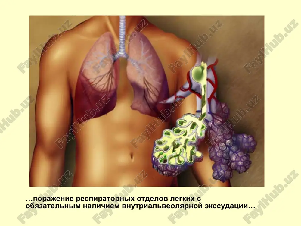 eykotsitoza bolee 10x109/l i/ili palochkoyadernogo sdviga bolee 10%. * pravostoronnyaya verxnedolevaya pnevmoniya * pravostoronnyaya nijnedolevaya pnevmoniya http://www.indyrad.iupui.edu/public/stalexan/sol2000/virthospblack.html * tyajyolaya pnevmoniya termin "krupoznaya pnevmoniya" vstrechaetsya tolko v russkoy meditsinskoy literature i vvel ego sergey petrovich botkin dlya videleniya bolnix s tyajelim techeniem dolevoy pnevmonii so stonushim dixaniem, krupom. * marshrutizatsiya patsienta tyajyoloe sostoyanie patsienta absolyutnie pokazanie k gospitalizatsii – dixatelnaya nedostatochnost (sa02<90) ugroza shoka (gipotoniya, taxikardiya) chdd bolee 30 v minutu porajenie bolee odnoy doli narusheniya soznaniya leykopeniya menee 4 trombotsitopeniya menee 100 gipotermiya soputstvuyushie zabolevaniya pojiloy vozrast differentsialnaya diagnostika provoditsya s tuberkulyozom, infarktom lyogkogo (tela), eozinofilnim infiltratom, opuxolyami lyogkix i drugimi sostoyaniyami, sposobnimi vizivat sindrom infiltratsii na rentgenogrammax organov grudnoy kletki (naprimer, sistemnie vaskuliti, volchanochniy pnevmonit, okrugliy atelektaz i dr.). * infiltrativniy tuberkulyoz lyogkix dvuxstoronnyaya verxnedolevaya infiltratsiya * polostnie obrazovaniya v s1-2-6 (reje – s10). * lokalizatsiya v verxne-zadnix smegmentax 1-2-6 * tuberkulyoz lyogkix u vzroslix: rentgenologiya 1-2-6, reje 10-y …