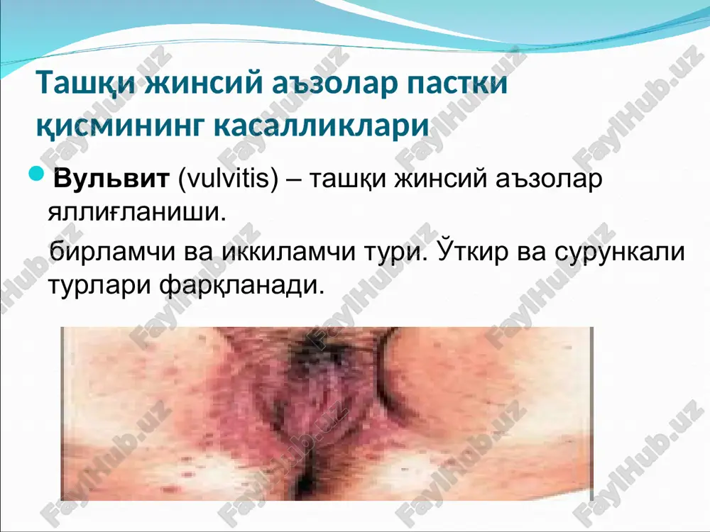 irlari soxasi bo'ylab sezuvchan. diagnostika anamnez, klinik, bakterioskopik, bakteriologik tekshiruvlar umumiy qon taxlili – leykotsitoz, soening ortishi uzi kasallik 8-1 0 kun davom etadi, to'g'ri davolanganda to'la sog'ayib ketadi. kam xollarda surunkaliga o'tadi. davolash yotoq rejimi qorin pastiga sovuq qo'yish sezuvchanlikga qarab antibiotklar qo'llash dezintoksikatsion terapiya umumiy quvvatlovchilar qo'llash desensibillovchi terapiya salpingooforit salpingooforit (adneksit) – bachadon ortiqlarining yallig'lanishi . yallig'lanish dastlab naylarning shilliq qavtida rivojlanadi, so'ng boshqa qavtlariga tarqaladi. saktosalpinks – qopsimon xosilalar nay yo'lini to'la berkitadi. piosalpinks – eksudatning yiringlashishi. klinika o'tkir, o'tkir osti va surunkali boshlanadi. o'tkir salpingooforitda: - qorin pastida va belda og'riqlar; - tana haroratining ko'tarilishi; - dizurik va dispeptik o'zgarishlar; - soe ning ortishi; - leykoformulaning chapga siljishi; - qorin paypaslanganda og'riq va mushak ximoyalanish xissi klinika surunkali salpingooforit: -bachadon ortiqlarining qattiqlanishi, xarakatining chegaralanishi, og'riqli palpatsiya; - uzoq asoratli davom etadi. diagnostika anamnez ob'ektiv tekshiruvlar laborator taxlillar qo'shimcha tekshiruv usullari gisterosalpingografiya gidrosonografiya differentsial diagnostika - …