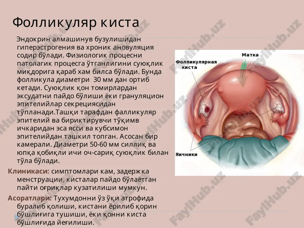 astatik biriktiruvchi tukimali fibroma sarkoma teratoidli dermoidli kista teratoblastoma gormonal usmalar follikuloma tekoma androblastoma epetileal o'sma (tsistoadenoma) a) tselioepitelial(seroz) o'smalar 1. oddiy –yaxshi sifatli tuxumdon o'smalari bo'lib, asosan bachadonning yon va orqa tomonlarida joylashib,uncha katta bo'lmagan ichi rangsiz suyuqlik bilan to'lgan bo'ladi. 2. papillyar - bir yoki bir necha kamerali bo'lishi mumkun. asosiy farqi bunda qo'pol so'rg'ichsimon bo'rtiqlar bo'lishidir. 50 % xollarda rakka aylanishi mumkun. papillyar kistomalar kattaligi va shakli turli tuman bulib diametri 25 sm gacha. ular kupincha bir kamerali va sillik yuzali buladi. bir necha kameradan iborat ( polikistoz )bolsa , yuzasi gadir-budur boladi. kistoma yuzasida surgichsimon usimtalar bolmasa , silliq va yaltiroq bo'lib ko'rinadi. tuxumdon papillyar epiteliysi polimorf bo'lib,ko'p qavatlibo'lib joylashgan. epetileal b) psevdomutsinoz usmalar 1. setsirlanuvchi 2. proliferatsiyalanuvchi. shakllari turlicha boladi. yuzasi g'adir budur bo'lib, bo'shlig'i jelesimon suyuqlik bo'ladi. proliferatsiyalanuvchi turi esa 20 % xavfli formasiga o'tib ketishi mumkun. bu formasi klimakterik va postklimakterik davrda uchrab, …