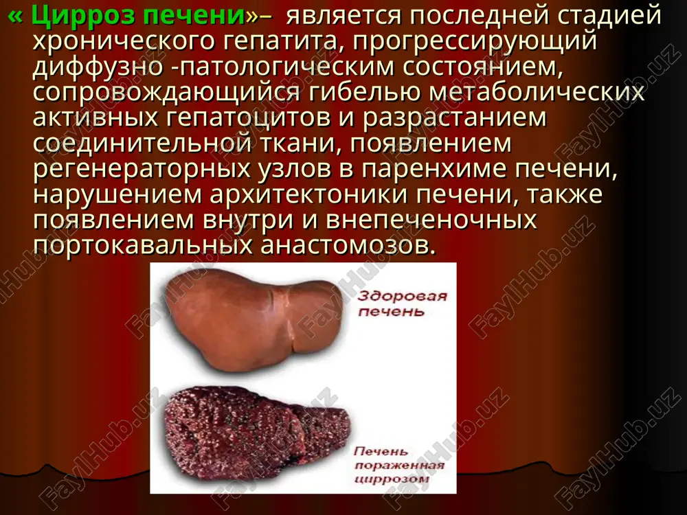 echno-skeletnie-sinovit, boli v sustavax, barabannie palochki, sudorogi. kojnie- teleangiektazii, palmarnaya eritema, jeltuxa. dlitelniy zapor. vzdutie jivota. bistroe utomlenie. besprichinnoe poxudenie. toshnota posle priema jirnoy pishi. poyavlenie kojnix zvezdochek. poyavlenie ksantelom. vipadenie volos u jenshin i d.t. diagnostika. iz anamneza - virusniy gepatit. - nasledstvennaya predraspolojennost. - alkogolizm. - nalichie xronicheskix zabolevaniy. - dolgoe primenenie lekarstvennix preparatov i t.d. pri laboratornix issledovaniyax nalichie ili otsutstvie aktivatsii (tsitoliza) v pecheni, - protsess mezenximalnogo vospaleniya, - vajno opredelit protsessi gepatodepressii i xolestaza klinicheskie priznaki vstrechaemie pri tsirroze pecheni: «pechenochnaya ladon», «ginekomastiya». ksantomatoznie izmeneniya na koje bolnix «sosudistie zvezdochki» ( teleangiektaziya) pri tsp v stadii dekompensatsii mexanizm vozniknoveniya astsita teoriya «nedostatochnogo napolneniya sosudistogo rusla» 50% 10% 90% videlyayutsya 3 stadii klinicheskogo techeniya tsp. eti stadii opredelyaetsya sleduyushimi simptomami i laboratornimi dannimi. klinicheskie simptomi: entsefalopatiya. astsit. krovotechenie. labaratornie dannie: tsitoliticheskie fermenti – alt, ast. dayushee znat o gepatodepressii – pti, gipoal-buminemiya. dannie xolestaza - bilirubinemiya …