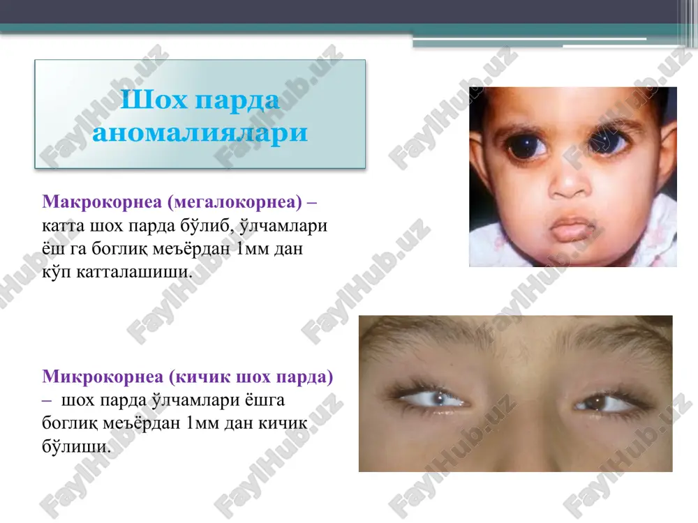 r parda bilan tutashgan -belmo xosil bulishi kuzatiladi. shox parda o'rmalovchi yarasi triada simptomi: o'rmalovchi yara (2 ta qirg'og'i -progressiyalanuvchi regressiyalanuvchi) iridotsiklit gipopion tuberkulyoz-allergik (fliktenulez, skrofulez) keratit shox pardada odatda limbda yarim shaffof kulrang do'ngliklar– fliktenalar paydo bo'ladi zaxm keratiti ko'z olmasi aralash in'ektsiyasi chuqur kulrang-pushti infiltratlar (ko'shilishga moyil) jarayonni davriyligi kupincha jarayon ikki tomonlama shox parda o'rta va chuqur qavati shikastlanishi kasallik davomiyligi 1 yilgacha 6-20 yosh da namoyon bo'ladi (2-3 chi qatlam) keratitlar gerpetik tuberkulez- allergik bakterial tuberkulez- metastatik zaxm korneal sindromi perikorneal in'ektsiya shox parda infiltrati shox parda sezgirligi pasayishi shox pardada qon tomir virajenniy rogovichniy sindrom fliktena na rogovitse *ko'z olmasi aralash in'ektsiyasi *sarg'imtir-yashil infiltrat gipopion *ko'z olmasi aralash in'ektsiyasi *chuqur sarg'imtir-kulrang aloxida infiltratlar kupincha 1tomonlama *ko'z olmasi aralash in'ektsiyasi *chuqur sarg'imtir-pushti infiltratlar *jarayon davriyligi *ko'pinchv 2taraflama yon tarafdan yoritish usuli kombinatsiyalangan usulda flyuorestsein bilan shox parda sezgirligini aniilash usuli immunologik ko'rsatkichlar umumiy klinik tekshiruvlar laborator …