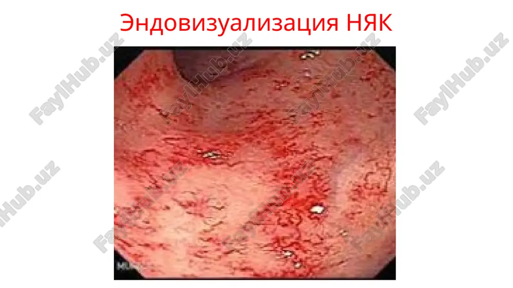gaz. 3. perforatsiyadan oldingi bosqich - klinik ko'rinishlar progressiyalanishi, ichak massalari va o't aralash va “kofe quyqasiga” o'xshash qusish, qorin old devori taranglashgan va og'riqli, ichak perestaltikasi eshitilmaydi, oshqozon ichak trakti falaji siptomatikasi, axlat yo'q yoki qizg'ish qon aralash, toksikoz va degidratatsiya belgilarining kuchayganligi, dvs qo'shilishi, perforatsiya xavfi yoki xolati. 4. perforatsiya va peritonit bosqichi - peritoneal shok, qorin bo'shlig'idagi hovo bo'lishi hisobidagi klinik belgilar, perforativ peritonit belgilari (axlat qusish, qorin dam bo'lishi, qonin old devori tarang va og'riqli, ichak peristaltikasi yo'q. jigar to'mtoqligi yo'qolgan, axlat va el chiqishi kuzatilmaydi) degidratatsiya, infektsion toksikoz, qon aylanishning markazlashuvi siptomlari kuzatiladi. morfologik o'zgarishlar 20 ichak devori pnevmatozi morfologik o'zgarishlar 22 ichak devori pnevmatozi parvarish printsiplari: qoringa teginmaslik, oshqozon ichak tizimida engillik ta'minlash, enteral oziqlantirishni to'xtatish, parenteral oziqlantirishni boshlash, oshqozon va ichak dekompressiyasi uchun zondlash, kindik tomirlari orqali giperosmolyar preparatlarni quyishni to'xtatish. tinchlik va yaxshi parvarishni ta'minlash. mo'tadil haroratli muhit yaratish, turli nojo'ya ta'sirlarni …