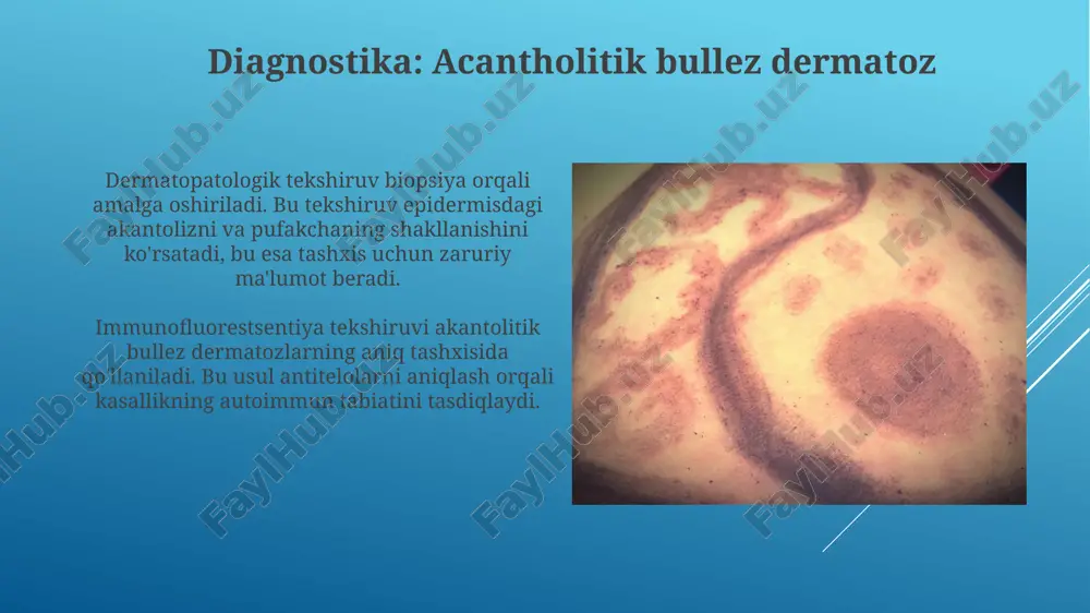 volashda muhim rol o'ynaydi. gluten eliminatsiyasi klinik ko'rinishlarni yaxshilaydi va dühring dermatitida dori-darmonga bo'lgan ehtiyojni kamaytiradi. teri biopsiyasida gistopatologik tekshiruv epidermal mikroabtsesslarni, neytrofillarning to'planishini va dermaning papillar qismida yallig'lanish infiltratini aniqlaydi, bu dühring dermatitiga xosdir. acantholitik bullez dermatoz: umumiy ko'rinish pemphigus vulgaris - eng keng tarqalgan turi, og'iz bo'shlig'ida yaralar paydo bo'lishi va teri qoplamida pufakchalar hosil bo'lishi bilan xarakterlanadi, 50 yoshdan oshganlarda ko'p uchraydi. dori vositalari, masalan, penitsillamin, ba'zi hollarda pemphigusni qo'zg'atishi mumkin; bu holat dori-induktsiyalangan pemphigus deb ataladi va kasallikning asosiy sababi hisoblanadi. e'tiboringiz uchun rahmat @taqdimot_robot image2.jpg image3.jpg image4.jpg image5.jpg image6.jpg image7.jpg image8.jpg image9.jpg image10.jpg image11.jpg image12.jpg
