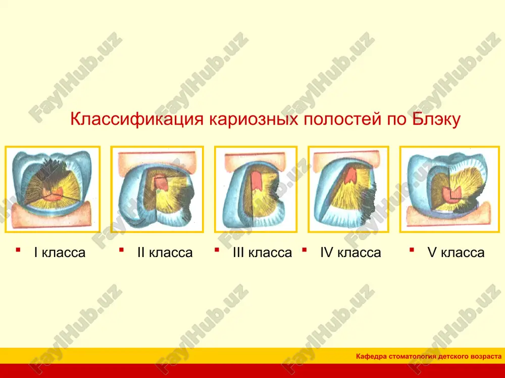 zviy napravlen v storonu vrasheniya samogo bora. k etoy gruppe otnosyatsya vse metallicheskie bori rejushego deystviya: almazniy instrument i karborundovie kamni snimayut bolee melkuyu strujku, tak kak imeyut bolee tonkoe (melkoe) pokritie s ostrimi granyami; deystvie ix na tkan bolee shadyashee: finiri i poliri za schet melkozernistoy ili gladkoy rabochey poverxnosti ne rejut, a lish shlifu i poliruyut obrabativaemuyu poverxnost. kafedra stomatologiya detskogo vozrasta obshie pravila preparirovaniya karioznix polostey tsel mestnogo konservativnogo lecheniya kariesa zubov — udalenie patologicheski izmenennix tkaney i vosstanovlenie anatomicheskoy formi i funktsii zuba, chto obespechivaet takje priostanovku karioznogo protsessa. osnovnimi metodami lecheniya kariesa (za isklyucheniem nachalnogo) v nastoyashee vremya yavlyayutsya issechenie porajennix uchastkov emali i dentina pri pomoshi vrashayushixsya borov i sozdanie takoy formi polosti, v kotoroy nadejno fiksirovalsya bi plombirovochniy material. kafedra stomatologiya detskogo vozrasta obshie pravila preparirovaniya karioznix polostey preparirovanie karioznoy polosti sostoit iz tochnix manipulyatsiy v predelax krayne maloy ploshadi i vklyuchaet ryad …