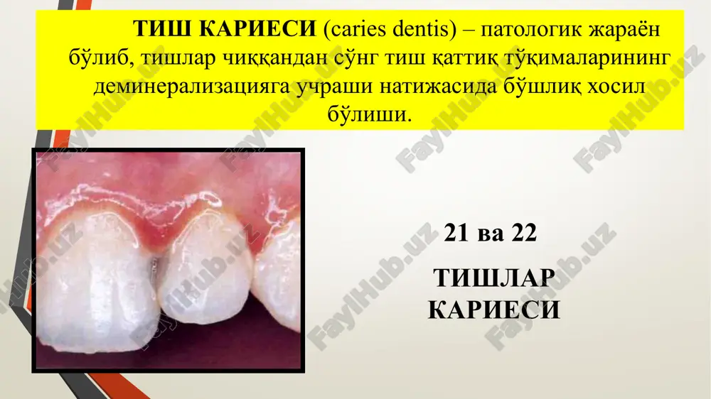 akllantirish kovak chetlariga ishlov berish (finirlash) karies kovakni ochish karies jarayoni dentinda emalga nisbatan tez kechganligi uchun, karies kovak ustida osilgan emal qavati bo'ladi va kovakni tubi kirish qismiga nisbatan ancha keng bo'ladi. karies kovagini ochishdan maqsad, osilgan emal qirralarini olish va kovakni ko'rish, charxlash va plombalash uchun sharoit yaratishdan iborat. kovakni ochishda olmos qirindili sharsimon yoki fissur borlar bilan, turbinali bormashinada (100000-350000 ay/daq.) olib boriladi. sharsimon bor bilan ishlashda borni harakati kovak tubidan qirrasi tomon olib borilishi lozim. fissur bor bilan ishlaganda, asosan borning yon qirralari bilan kovak devori vertikal, tekis bo'lguncha ochiladi karies kovagini ochishda quyidagi qoidaga rioya qilish lozim: borning hajmi karies kovagining kirish teshigi hajmidan katta bo'lmasligi kerak ikkita bir-biriga zich yopishib turgan tishlarni shu tomonidagi karies kovagini ochishda o'zgarmagan to'qimani (emal va dentin) olishga to'g'ri kelib, kovakni chaynov yoki til yuzasiga olib chiqiladi karies kovagini kengaytirish blekning “profilaktik kengaytirish” usuli. bu usul tish qattiq to'qimasini …