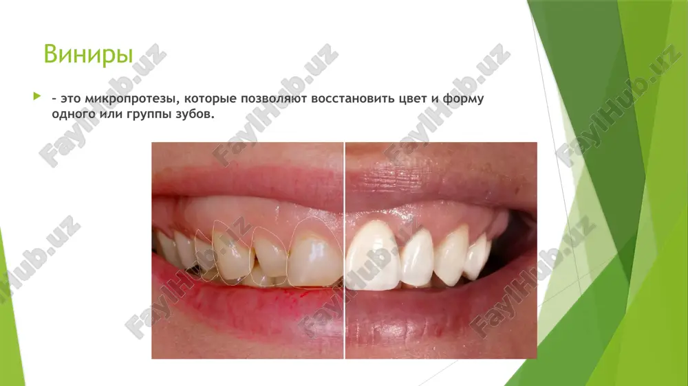 ri zubov, texnik na diagnosticheskoy modeli provodit voskovoe modelirovanie budushey restavratsii i peredaet vrachu-stomatologu prozrachniy (dlya izgotovleniya probnoy restavratsii) i silikonoviy shabloni. vibor instrumentov obrabotka zubov provoditsya pri pomoshi almaznix instrumentov razlichnoy konfiguratsii i zernistosti. dlya zashiti ryadom stoyashix zubov sleduet ispolzovat metallicheskuyu matritsu, dlya zashiti desnevix tkaney – instrument zekrya gingival etapi preparirovaniya 1) markirovka glubini preparirovaniya vestibulyarnoy poverxnosti 2) soshlifovivanie vestibulyarnoy poverxnosti s odnovremennim formirovaniem prisheechnogo ustupa 3) preparirovanie kontaktnix poverxnostey 4) soshlifovivanie rejushego kraya 5) okonchatelnoe oformlenie ustupa i sglajivanie ostrix graney markirovka glubini preparirovaniya proizvodyat v 2 ploskostyax, povtoryayushix estestvenniy vestibulyarniy kontur poverxnosti zuba: pervaya – pridesnevaya, vtoraya – rejushaya, sootvetstvuyushaya estestvennomu okklyuzionnomu naklonu zuba, ravnomu 30-35 gradusov. soshlifovivanie v odnoy ploskosti privedet k sozdaniyu nedostatochnogo prostranstva dlya keramicheskoy oblitsovki na rejushey treti. takje soshlifovivanie v odnoy ploskosti, pri kotorom obrazuetsya dostatochnoe prostranstvo dlya oblitsovki, podoydet na opasno blizkoe rasstoyanie k pulpe. markirovka glubini preparirovaniya dlya …