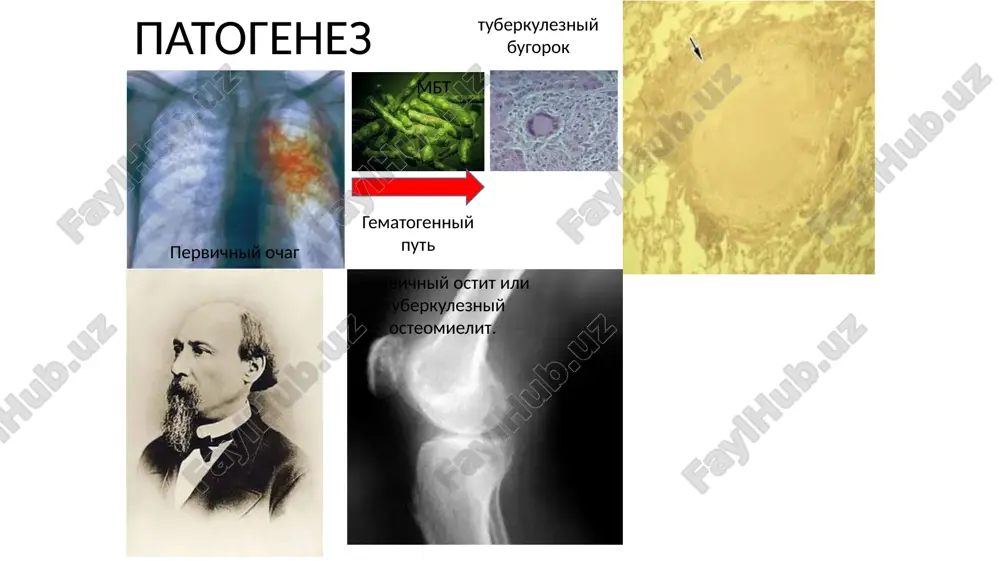 xolatida ushlab, avaylashga xarakat qilishadi. masalan ko'krak yoki bel spondiliti bo'lgan bemor polda yotgan predmetni olish uchun oldiniga o'tiradi va undan keyingina predmetni oladi. oyoq qo'llarning majburiy xolati bo'g'imlarning turg'un kontrakturalariga sabab bo'ladi noaniq bo'lgan xolatlarda bo'g'im bushlig'i punktsiya qilib ko'riladi. ko'pincha bo'g'imlar urchuqsimon qalinlashgan bo'lib, ustidagi terisi yupkalashgan va oqish rang bo'ladi suyuq yiring, kazeoz parchalanish maxsulotlari, ba'zan esa suyak sekvestrlari ajralib turadigan oqma yaralar paydo bo'ladi bakteriologik tekshiruvda sil tayoqchalari topiladi; biologik usul esa dengiz cho'chqalariga yiring suspenziyasini in'ektsion usulda kirtishdan iborat bo'lib, 6 xaftadan keyin sil disseminatsiyasi kuzatiladi. vaqt o'tishi bilan xosila ustidagi teri yallig'lanadi, ko'p miqdorda yiring ajraluvchi oqma yaralar paydo bo'ladi suyak-bo'g'im silining asoratlari 1. parenximatoz a'zolar amiloidozi 2. silning miliar turlari rivojlanishi kech postartritik bosqichida: 1. umurtqa pog'onasi bo'g'imlarining deformatsiyasi 2. oyoq qo'llarning kaltalanishi 3. gavda ko'rinishining o'zgarishi 4. patologik sinishlar chiqishlar diagnostikasi tashxis qo'yish uchun rentgenologik tekshiruv usuli asosiy o'rinni egallaydi. suyaklarning qayta …