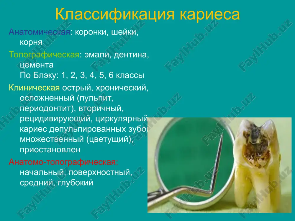 -markeri sredniy karies sredniy karies navisayushaya emal, demineralizovannaya zona demineralizatsii, nekroza dentina zona intaktnogo dentina zona gipermineralizatsii, prozrachnogo dentina zona tretichnogo, zamestitelnogo, irregulyatornogo dentina ostriy xronicheskiy lechenie srednego kariesa - obezbolivanie (preimushestvenno pri ostrom techenii) - preparirovanie k / p (raskritie, nekrektomiya) - obrabotka k / p, visushivanie - izoliruyushaya prokladka (dlya postoyannix plomb, toksichnix dlya pulpi - postoyannaya plomba - shlifovka, polirovka glubokiy karies glubokiy karies navisayushaya emal demineralizovannaya, belaya zona demineralizatsii, nekroza, dentina zona gipermineralizatsii, prozrachnogo dentina zona tretichnogo, zamestitelnogo, irregulyatornogo dentina otsutstvuet zona neizmennogo dentina pervichnie izmeneniya v pulpe vospalitelnogo x-ru ostriy xronicheskiy ostriy glubokiy karies lechenie v dva posesheniya: 1-e poseshenie obezbolivanie preparirovaniya karioznoy polosti (na dne mojet ostatsya izmenenniy dentin) na dno karioznoy polosti nakladivaetsya odontotropnaya pasta (ot 14 dney do 1 mesyatsa) vodniy dentin, dentin-pasta, tsement = vremennaya plomba lechebnie prokladki na osnove gidrookisi sa vodnaya suspenziya gidrookisi sa: kalradent, kalasept, calcipulp, calcicur, calcium …
