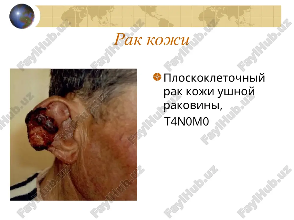 ezіnku і lіmfovuzli bolnoy k., 34 goda 03.2000 - melanoma koji na spine, t3bn0m0 lechenie: - bf-rt, svd 80 gr, operatsiya pxt + laferon (2 kursa) 04.2001 - metastazi v l / uzli i selezenku 04.2001 melanoma: metastaticheskoe porajenie selezenki i limfaticheskogo uzla “in transit” metastazi metastaticheskaya melanoma palliativniy kurs - terapii gormonoterapiya podderjivayushaya terapiya profilaktika melanomi zaklyuchaetsya v svoevremennom udalenii pigmentnix pogranichnix nevusov, ogranichenii ultrafioletovogo oblucheniya (ratsionalniy zagar, texnika bezopasnosti na proizvodstve), preduprejdeniya travmirovaniya uchastkov razmesheniya nevusov.