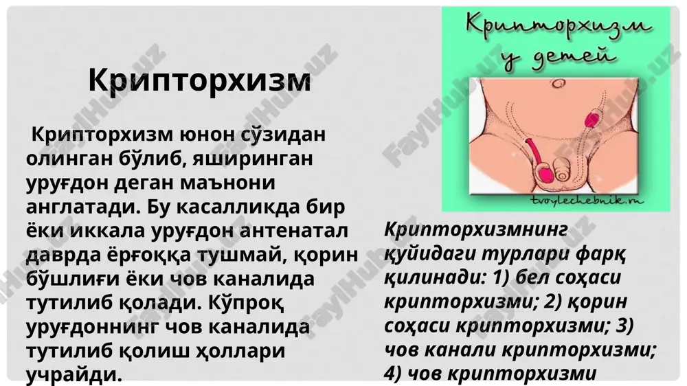 oshganlarda esa 85,7% rolda farzandsizlik kuzatilgan. (lyudvig, 1976). shuni hisobga olib, 4—6 yoshda emas, balki 1 yoshda orxipeksiya—operatsiyasini bajarish kerak, degan fikrga kushiluvchilar soni ortib bormokda. shuni hisobga olish kerakki, qorin sorasida kolgan urug'donda, uning odatiy urnida joylashganiga nisbatan 68 marta kuprok, xavfli usma—seminoma rivojlanadi. shuning uchun kriptorxizmga duchor bulgan bolalarni albatta operatsiya qilmoq lozim. varikotsele urug' tizimchasi vena tomirlarining kengayishi varikotsele deb ataladi. etiopatogenezi xastalik rivojlanishida urug'don venalarida bosimning ko'tarilishi hamda tomirlar tonusining pasayishi katta ahamiyatga ega. urug' tizimchasi atrofi pardasining zaifligi ham varikotselega moyillik tug'diradi. chap urug'don venasida bosim ko'tarilishining sababi, uning buyrak venasiga ma'lum burchak ostida qo'shilishi hamda buyrak venasining o'ziga xos torayishidir. bu hol varikotselening chap tomonda uchrashiga sabab bo'ladi. klinikasi rivojlanish darajasiga bog'liq. boshlanish davrida shikoyatlar bo'lmaydi. kasallik rivojlangan sari urug'don, urug' tizimchasi, chot orasi va chov kanali tomonlarida og'riq paydo bo'ladi. yorg'oqtsagi og'riq yuk ko'targanda kuchayadi. qarab ko'rganda yorg'oq terisi va urug'don ko'proq osilganligi, …