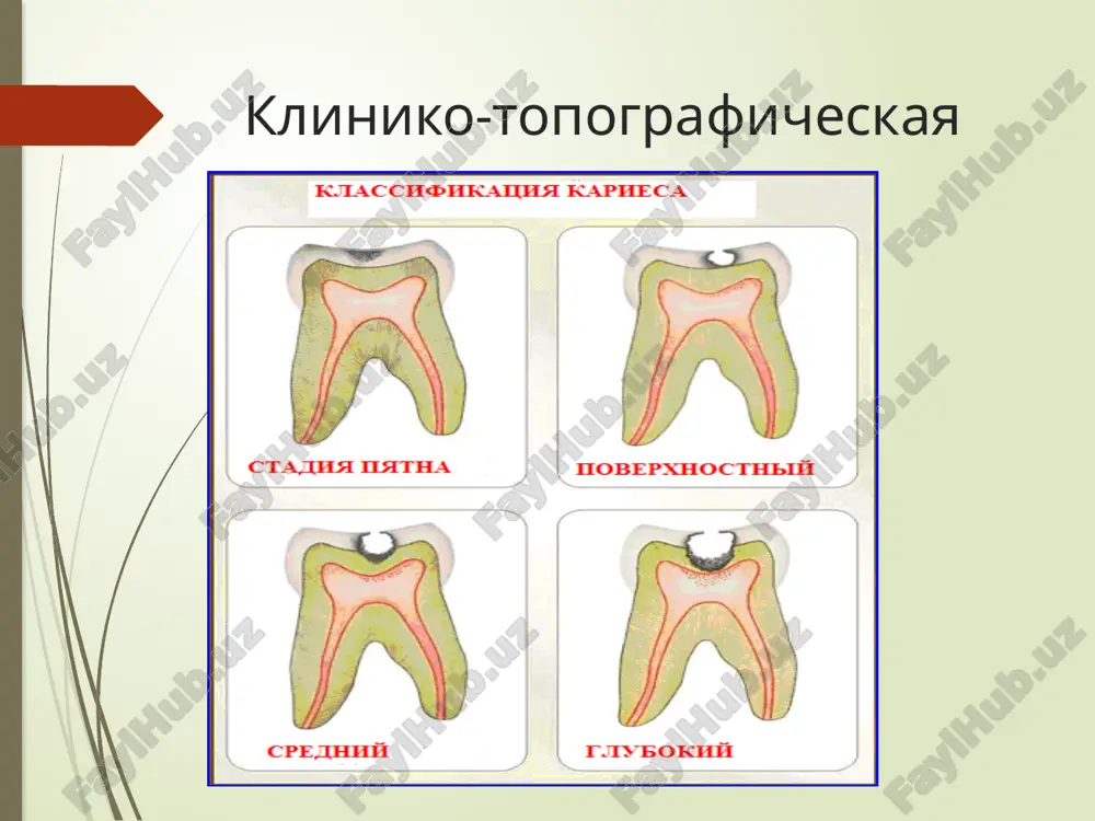 erxnost zubov napravlyayut puchok uf luchey iz lyuminestsentnogo osvetitelya (old -41) s rasstoyaniya 20 – 30 sm. zdorovie tkani zuba flyuorestsiruyut snejno-belim, golubovatim svecheniem. v oblasti karioznogo pyatna otmechaetsya gashenie lyuminestsentsii. diagnostika nachalnogo kariesa dlya obnarujeniya «skritix» karioznix porajeniy zubov, lokalizuyushixsya na kontaktnix poverxnostyax koronok ili v oblasti fissur jevatelnoy poverxnosti, primenyaetsya metodika transillyuminatsii s ispolzovaniem galogenovoy lampi lazernaya diagnostika s ispolzovaniem apparata «diagnodent», razrabotanniy nemetskoy firmoy kavo. apparat «diagnodent» ispolzuetsya dlya diagnostiki nachalnogo kariesa v tex sluchayax, kogda ego trudno opredelit vizualno (naprimer, ochagi demineralizatsii raspolojeni na kontaktnix poverxnostyax zubov ili v oblasti fissur jevatelnoy poverxnosti). apparat «diagnodent» uroven izmeneniy, proisxodyashix v tkani, otrajaetsya na displee pribora v vide tsifrovix pokazateley i soprovojdaetsya zvukovim signalom. pribor pozvolyaet viyavit trudnodostupnie dlya diagnostiki zoni demineralizatsii, fissurniy karies, protsess na aproksimalnix poverxnostyax, uroven nekrotomii pri operativnom preparirovanii polosti. deystvie pribora ne vizivaet nikakix nepriyatnix oshusheniy u bolnogo. vizualnoe obsledovanie emali s pomoshyu …