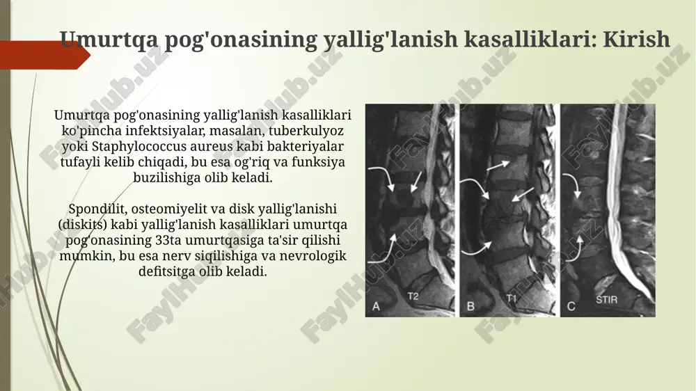 boʻlishi mumkin. disk churrasi va protrusiyasi disk churrasi - bu umurtqalararo diskning yorilishi boʻlib, unda pulpoz yadrosi yorilib, orqa miya kanaliga chiqadi va ogʻriqni keltirib chiqarishi mumkin. churra ko'pincha l4-l5 yoki l5-s1 segmentlarida joylashadi. disk protrusiyasi - bu diskning tashqi qatlamining (fibroz halqa) deformatsiyasi, lekin yorilmasdan, 3 mm dan kam chiqishi bilan xarakterlanadi. bu holat og'riqni keltirib chiqarishi mumkin. umurtqa pog'onasi stenoz umurtqa pog'onasi stenozida umurtqa kanalining torayishi nerv ildizlari va orqa miyaga bosim o'tkazib, og'riq, uyushish va zaiflik kabi nevrologik simptomlarni keltirib chiqarishi mumkin. ko'pincha 60 yoshdan oshganlarda uchraydigan umurtqa pog'onasi stenozi, osteoartrit, disk churrasi va ligament gipertrofiyasi kabi degenerativ o'zgarishlar natijasida rivojlanishi ehtimoli yuqori. spondilolistez spondilolistez - bu umurtqa pog'onasining bir umurtqasining boshqasiga nisbatan oldinga siljishi, ko'pincha l5 umurtqasi s1 umurtqasi ustida siljiganida kuzatiladi. ushbu holatning sabablari orasida umurtqa suyagining defekti (spondiloliz), travma yoki degenerativ o'zgarishlar bo'lishi mumkin, ko'pincha 50 yoshdan oshgan odamlarda uchraydi. diagnostika usullari (klinik tekshiruv, …