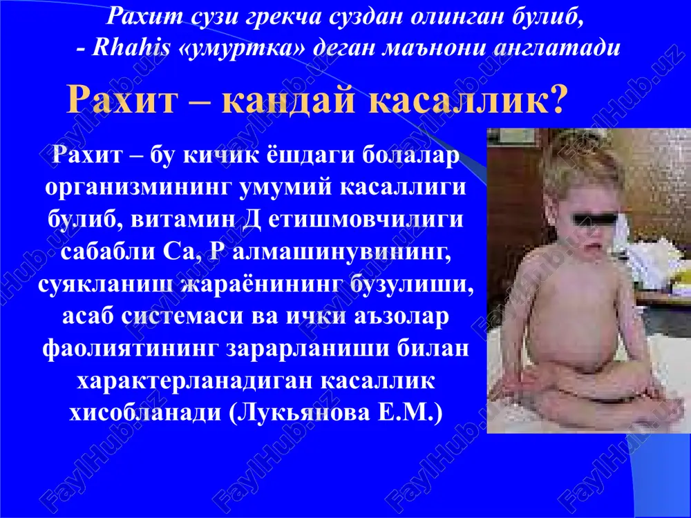 kamayishi tsitratlar sintezini pasayishi oksil va boshka modda almashinuvini buzilishi gipokaltsiemiya gipofosfatemiya atsidoz aminoatsiduriya kollagin sintizini buzilishi kalkon oldi bezi stimulyatsiyasi buyraklarda fosfatlar riabsorbtsiyasini pasayishi osteoklastlar stimulyatsiyasi osteoblastlar tormozlanishi suyaklarni demineralizatsiyasi suyaklar shaklining buzilishi osteopatiya mushaklar gipotoniyasi nerv sistemasining buzilishi oshkozon-ichak trakti funksiyasini buzilishi raxitning tasnifi s.o. dulitskiy 1947 davriga karab faollik darajasi kechishi boshlangich avj olgan davri tiklanish davri koldik asoratlar davri i – daraja engil ii – daraja urta ogir iii- daraja ogir darajasi utkir utkir osti kaytalanuvchi raxit kaltsiypeniya bilan kechuvchi shakli fosfopeniya bilan kechuvchi shakli kaltsiy va fosfor mikdorining yakkol uzgarishlarsiz e.m. lukyanova va xammual. 1988 yil davriga karab faollik darajasi kechishi boshlangich avj olgan davri tiklanish davri koldik asoratlar davri i – daraja engil ii – daraja urta ogir iii- daraja ogir darajasi utkir osti kaytalanuvchi raxit raxitning klinikasi kasallikning boshlangich davri: bolaning 1-1,5 oyligidan boshlanib, 3-4 oyligida yakkol namoyon buladi. belgilari: ko'p terlash, bezovtalik, …