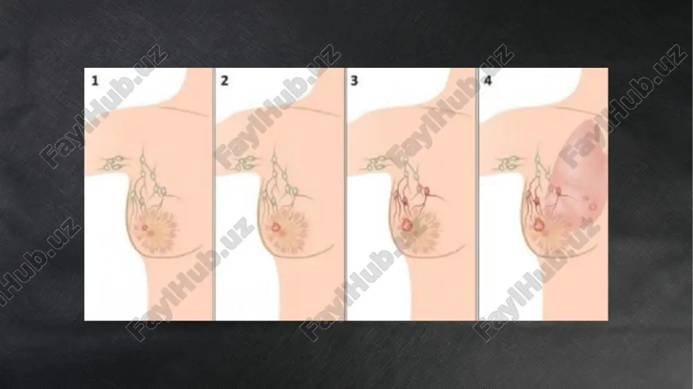 quyi 1/3 qismiga o'tgan. gidronefroz yoki buyrak ishi buzilishi mumkin (chaqishishi sababli). bachadon tana mioma etiologiya: gormonal buzilish (giperestrogeniya), nasliy omillar. patogenez: miometriy smusk hujayralari giperplaziyasi → mioma tugunlari. davo taktikasi: kichik va simptomsiz – kuzatish; gormonal terapiya; katta bo'lsa – miomektomiya/gisterektomiya. endometriy polipi etiologiya: giperestrogeniya, yallig'lanish. patogenez: endometriyning mahalliy giperplaziyasi. davo taktikasi: gisteroskopik polipektomiya, gistologiya. i-daraja (i stadiya) shish (opuxol) faqat bachadon tanasida (endometriyda) joylashgan. chuqurligiga qarab: ia – faqat endometriyda yoki miometriyning yarmidan kam qismiga kirgan. ib – miometriyning yarmidan ko'proq qismiga kirgan. ii-daraja (ii stadiya) shish bachadon bo'yniga (shiyka matkiga) tarqalgan, lekin bachadon tashqarisiga chiqmagan. iii-daraja (iii stadiya) shish bachadon tashqarisiga tarqalgan, lekin qovoq (pelvis) tashqarisiga chiqmagan. podstadiyalari: iiia – bachadon tashqi qatlamlari yoki tuxumdon, naylarga tarqalgan. iiib – qin yoki pelvik devorga o'tgan. iiic – aylanasidagi limfa tugunlariga metastaz bergan. tahnk you image1.png image2.jpeg image3.jpeg image4.png image5.jpeg image6.jpeg image7.jpeg