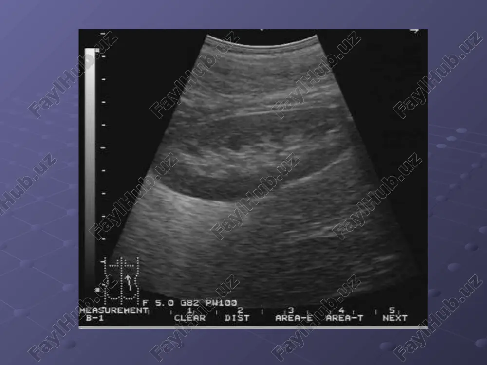 sonografiya: giperexogen, katta bulsa nogomogen (nekroz, kon, kaltsinat-20%), buyrak diffuz eki kisman katta, 15%-kistoz usma eu: funktsiya pasaygan, gidronefroz, usma bushligi kontrastga tulishi, kosacha jom siljishi va usma invaziyasi. kt: + 1) zichligi > + 20 n, kaltsinat, atrof tukima + limfa tugunlar xolati (boskichi) kontrast kt: geterogen kontrastlanish. buyrak venasi trombozi. mrt: tarkalishi yaxshirok aniklaydi tosh kasalligi sono: 1)  5 mm 2)giperexogen 3) akustik soya 4) gidronefroz rentgen: oxaklashgan tosh (oxaklanish xos!!!) eu: oxaklashmagan tosh – tulish defekti 1) zich nefrogramma - “ok buyrak” 2) kech va uzok kontrastlanish 3)gidronefroz 4) su-runkali - buyrak kontrast yigmaydi renografiya: obstruktiv chizik spiral kt: siydik nayida 1-2 mm tosh gidronefroz– buyrak katta, kosa-jomlar keng, parenxima yupka, funktsiya  tugma anomaliyalar buyrak aplaziyasi buyrak gipoplaziyasi, (dtx: bujmaygan buyrak - funktsiya yuk) buyraklar distopiyasi - bel, enbosh, toz va karama-karshi distopiya (dtx: nefroptoz - siydik nayi uzunligi normal) buyrak ikkilanishi buyraklar birikishi (takasimon) …
