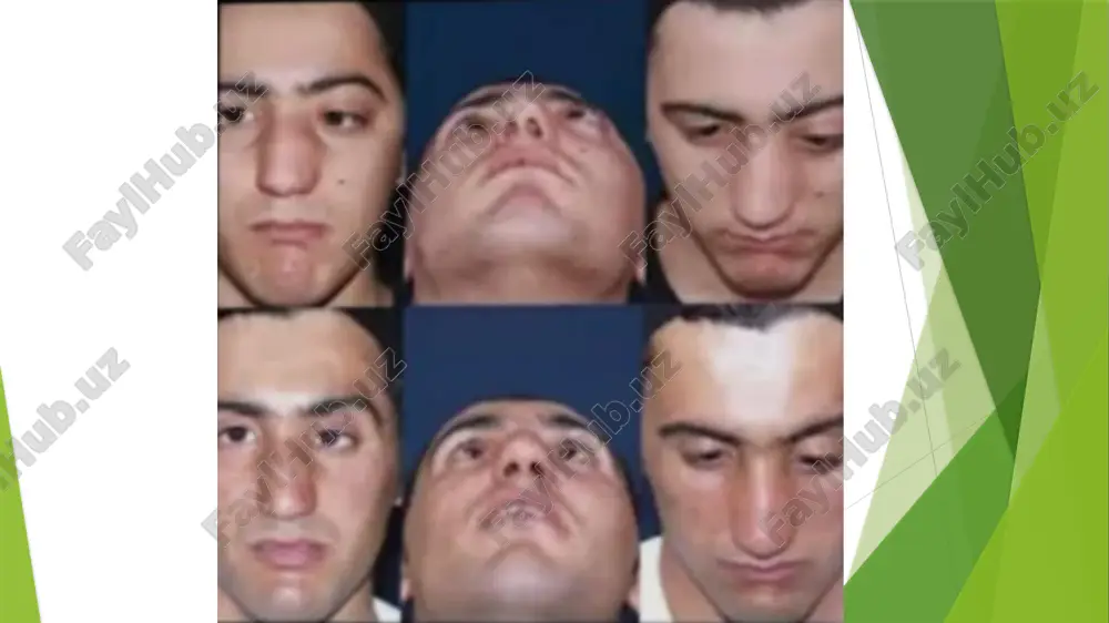 burun halqum angiofibromasi - Page 3