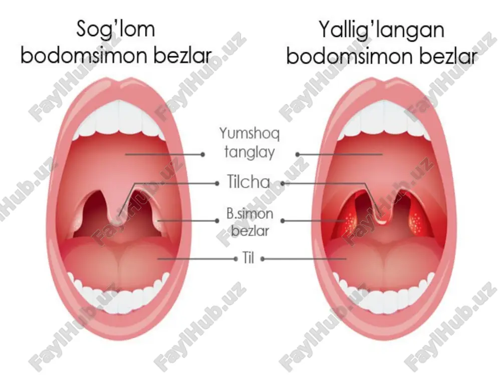 yaralar (yara-pardali angina); hududiy limfadenit. angina tomoq og'rig'i va tana haroratining keskin ko'tarilishi (39-40 °c gacha, ba'zan 41 °c gacha) bilan boshlanadi. tomoqdagi og'riq, qoida tariqasida kuchli va o'tkir, ammo mo'tadil bo'lishi ham mumkin. limfa tugunlari kattalashadi. ular pastki jag' ostida yaxshi palpatsiyalanadi va og'riqli hisslar chaqiradi. angina shuningdek, pastroq tana harorati bilan ham kechishi mumkin — 37 dan 38 °c gacha, ammo tomoqning shikastlanishi kengroq bo'ladi. differentsial tashxis tomoqdagi og'riq ko'pincha o'rvi da ham kuzatiladi, ayniqsa adenovirus kelib chiqishli infektsiyalarda, ammo bunda limfa tugunlarining kattalashishi nisbatan kam uchraydi. bodomsimon bezlarning kuchli yallig'lanishi va limfa tugunlarini doimiy ravishda kattalashishi infektsion mononukleozning asosiy belgilari hisoblanadi, buni kengaytirilgan qon tahlili bilan tasdiqlash mumkin. instrumental tashxislash kasallikni asosiy diagnostik usuli bu halqumni tekshirish — faringoskopiya, shuningdek, bemorning shikoyatlari va kasallik anamnezini baholashdir. bundan tashqari, infektsiya turini aniqlash uchun bodomsimon bezlardan shilliq yoki yiring surtmasi olinadi. biomaterial turli xil tahlillarga yuboriladi: oziqa muhitiga ekish …