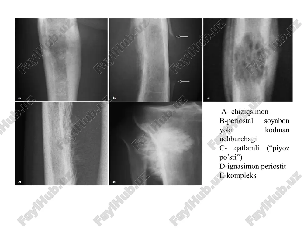 zichlashish sohasi, fragmentatsiya fazasi – suyak deformatsiyasi, bo'g’im yorig’i kengayishi, reparatsiya fazasi – tiklanish jarayonlari, 5 – faza – artroz belgilari. aseptik nekroz. son- chanoq bo’g’imi rentgenogrammasi. e'tiboringiz uchun rahmat! image1.jpeg image4.png image7.jpeg image12.jpeg image13.jpeg image15.jpeg