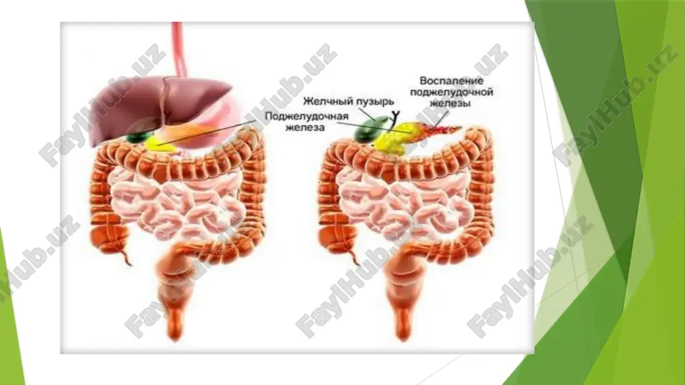 retor (normal yoki ortib borayotgan sekretsiya hajmi, bikarbonatlarning debeti, fermentlarning faolligi oshishi) - gipofermentativ (fermentlar, fermentlarning normal hajmi bilan bikarbonatlar ishlab chiqarishning pasayishi), obstruktiv. gipersekretor pankreatit bilan birinchi 2-4 kun davomida ochlik belgilanadi, so'ngra ular 5-sonli parhez stoliga o'tadilar. og'riq qoldiruvchi vositalar, antibiotiklar va boshqa dorilar ham buyuriladi. - sekretor yetishmovchiligi bo'lgan pankreatit, pankreatinga asoslangan ferment preparatlari shaklida almashtirish terapiyasini talab qiladi. - oshqozon osti bezi kanalining obstruktsiyasi bo'lsa, jarrohlik yoki teri orqali (punksion) davolash ko'rsatiladi. - oshqozon osti bezining uzoq muddatli oqmasi bilan jarrohlik yoki minimal invaziv punksion davolash qo'llaniladi. - psevdotumoroz pankreatit haligacha jiddiy muammo bo'lib qolmoqda. ko'pincha uni oshqozon osti bezi saratonidan ajratish mumkin emas, shuning uchun davolash asosan o'ziga xos klinik holatga bog'liq. image1.png image2.png image3.png image4.png image5.png image6.png /docprops/thumbnail.jpeg