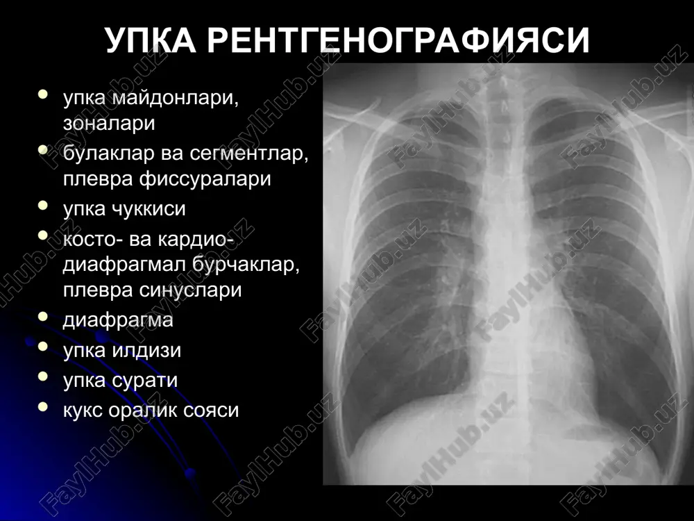 чами 2.5 см гача чегараси аник кальцинатлар секин усади аденома ёшларда купрок марказда (бронх ичида) усмани узи купинча куринмади упкада - гипо/гипер/гипо вентиляция ва ателектаз, еки сурункали пневмония куринса – 2 см гача, юмалок, гомоген, аник текис чегара. бошка шарсимон патология шарсимон пневмония - клиникаси уткир!, чегаралари нотекис, тез динамика метастазлар - «упкадаги тангалар» упкадан ташкари патология - ярим шар/овал шаклида халкасимон корайиш касалликлар - хаволи киста, каверна, абсцесс, периферик рак, поликистоз, бронхоэктазлар ахамиятли девор калинлиги ва текислиги суюклик даражаси атрофдаги инфильтрация девори калин бир текис эмас - периферик рак (+бошка белгилар) девори юпка бир текис - хаволи киста, санацияланган каверна девори калин бир текис - абсцесс, каверна. атрофда инфильтрация. куп сонли халкалар 1. бронхоэктазлар - тугма еки ортирилган - упканинг пастки кисмида, - диаметри 2 см гача, - фиброз + инфильтрация - r-графия сезгирлиги 40% (кт ва бронография!!) 2. поликистоз - тугма - бутун булак еки упкани эгалайди - …