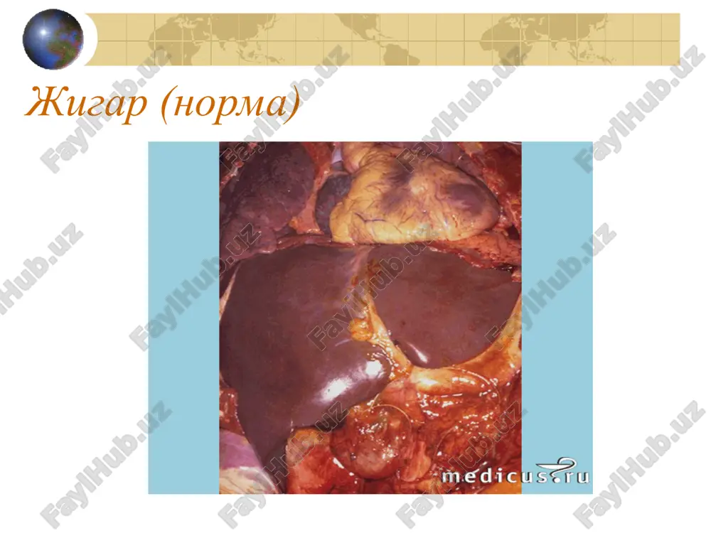 ар ҳосил бўлганлиги, жигар бўлакчалари орасида фиброз ўзгаришлар ривожланганлиги, гепатоцитларда дистрофик ўзгаришлар аниқланади. люпоидли гепатит - кўпинча аёлларда гормонал дисфункция даврида учрайди. люпоидли гепатитда жигар хужайралари деструкцияси аутоиммун жараёнлари, натижасида содир бўлади, 10 фоиз беморлар конида бўрича (le) хужайралари- мавжуддир. кўпчилик беморларда хасталик тўсатдан бошланади: харорат кўтарилади, бўґимларда ва коринда оғриқ, сариқлик., 1-6 ой давомида сурункали гепатит белгилари: қон томир юлдузчалари, кафт эритемаси ва гепатоспленомегамия пайдо бўлади. қонда гипербилирубинемия, гиперферментемия, юқори гамма глобулинемияли гиперпротеинемия, бўрича хужайралари ва ревматоид омили мавжудлиги аниқланади. тезда жигар циррози шаклланади. ташхиси жигар биоптатида доғли некроз ва фиброз аникланганда кўйилади. қон зардобида трансаминазалар, микдорининг кўпайиши ташхисни тасдиқлайди г. сурункали холестатик гепатит. жигар ичидаги ўт йўлларида ўт тўсилиши (холестаз) натижасида ривожланади ва жигарнинг билиар циррози билан якунланади. жигар ичидаги холестаз ўткир вирусли гепатитнинг холестатик тури окибатида, хамда сурункали холецистит, ўт тош касаллигида аникланади. хасталикнинг кўзиш даврида терида ва милкларда геморрагия белгилари, қичишиш, сарґайиш, уйқусизлик, қоринда оғриқ, ҳарорат …