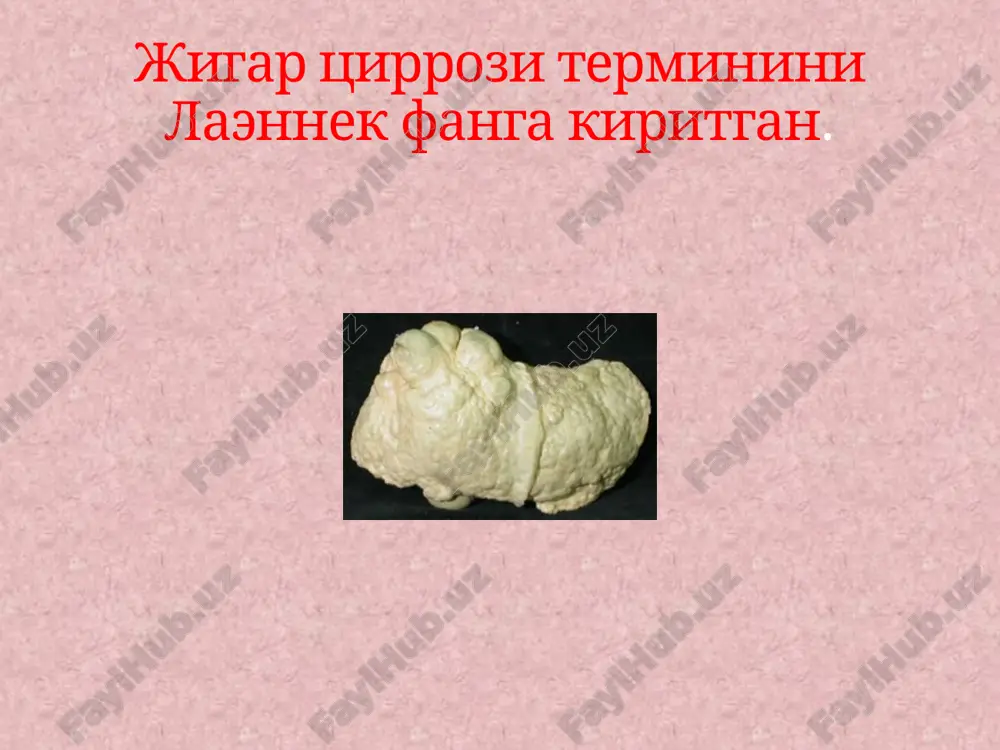 қориннинголд деворида кўриниши, асцит ва спленомегалия билан характерланади.спленомегалия гиперспленизм билан кечиши мумкин. касаллик белгилари : 16 ўргимчаксимон телеангиэктазиялар кафт эритемаси қулоқ олди ва кўз ёш безларининг катталашиши тирноқларнинг ўзгариши (мюрке чизиқлари, терри тирноқлари) «ноғора чўплари» кўринишида бармоқларнинг ўзгариши гинекомастия гепатоспленомегалия асцит ошқозон ичак тизими варикоз кенгайган веналаридан қон кетиши жигар энцефалопатияси клиник кўриниши медуза боши пальмар эритема гинекомастия томирли юлдузчалар лаборатор диагностик белгилар анемия эритроцитлар, лейкоцитлар, тромбоцитлар сони камайиб кетиши - гиперспленизм цитолитик жараён ва жигар етишмовчилиги белгилари: билирубин, аст, алт ларни ошиши альбумин, протромбин, холестерин, фибриногенларни камайиб кетиши диспротеинемия i 3 мм гача iii 5 мм кенгроқ ii 3-5 мм шерцингер а.к. таснифи бўйича варикоз кенгайган веналарни кенгайиш даражаси меъда ва қизилўнгач ввк жигар циррозларини даволаш даволаш: жигар циррозини даволаш куйидагиларга каратилади: 1. касалликни келтириб чикарадиган сабабларга ва бошка сабабларга карши кураш 2. касалликнинг ривожланиш жараёнига таъсир курсатиш 3. касалликнинг асоратларига карши курашиш верошпирон билан биргаликда бошка диуретиклар хам …