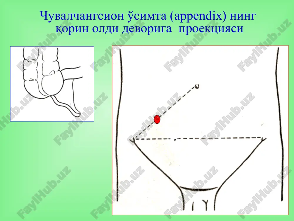 зара 5 ойдан бошланади. огрик юкори жойлашади, мушаклар таранглиги ривожланмаган, михельсон, брендо симптомлари мусбат. карияларда – клиник манзара ривожланмаган, мушаклар таранглиги йук, лейкоцитоз йук, тана харорати нормал ўткир аппендицит дифференциал ташхислаш корин бушлик аъзолари касалликлари кукрак кафас аъзолари касалликлари корин орти сохаси аъзолари касалликлари инфекцион касалликлар кон ва кон-томир касалликлари гинекологик касалликлар тери касалликлари неврологик касалликлар қорин бўшлиғини ультратовушли текшируви қорин бўшлиғидаги эркин суюқлик лапароскопия махсус диагностика усуллари * диагностик лапароскопия тўғридан – тўғри қорин бўшлиғидаги патологик жараённи, шу жумладан ўткир аппендицитни, аниқлашга ёрдам берадиган усул ялиғланган ва ўзгармаган чувалчангсимон ўсимтани лапароскопик белгилари (кригер а.г. бўйича, 2000) чувалчангсимон ўсимта инструментда эркин осилиб туради чувалчангсимон ўсимта шишган ва у инструментда эркин осилиб турмайди, сирғалиб тушиб кетади дьяконов-волкович бўйича кесма кесмани босқичлари апоневрозни кесиш мускулларни очиш қорин пардани кесиш операция босқичлари кўр ичак губазини чиқазиш чувалчангсимон ўсимтани жароҳатга чиқазиш чувалчангсимон ўсимта тутқичини боғлаш операция босқичлари кисет чокини қўйиш аппендэктомия ўсимта чўлтоғини чўктириш …