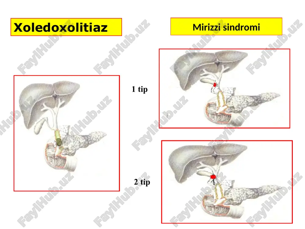 mumkin yoq yoki yoq xolsizlik bor bor yoq ut qopi kattalashgan kattalashmagan kattalashmagan yurak urishi bradikardiya bradikardia normal yoki tahikardia jigar kattalashgan kattalashmagan bir oz kattalashgan taloq kattalashmagan yarim holda kattalashgan kattalashgan mexnik sariqlik bilan bemorlarni davolash algoritmi i bosqich drenajlash dozali dekompressiya poliorgan yetishmovichilikning oldini olish ochiq jarrohlik amaliyotlar ii bosqich ichak ichiga normal o‘t passajini tiklash endoskopik retrograd amaliyotlar teri orqali jigar orqali endobiliar amaliyotlar natija bo‘lmaganda endoskopik retrograd endobiliar amaliyotlarga ko‘rsatma uttda xoledox diametri 8 sm dan ortiq; ms sababi aniqlanganda va patologik o‘zgarish o‘t yo‘lida bo‘lganda uttda o‘t yo‘llarni ko‘rish va farqlash imkoniyati bo‘lmaganda, giperbilirubinemiya kuzatilsa xoledoxolitiaz stenozlovchi papillit xoledox terminal qismini va katta duodenal so‘rg‘ichni 1,5 sm gacha bo‘lgan stenozi i va ii darajali jigar yetishmovchiligi bilan kuzatiladigan mexanik sariqlik qarshi kursatma oik – oui; mqub; uqte; une endoskopik papillosfinkterotomiya amaliyotiga ko‘rsatma kompensatsiya bosqichi jigar bioenergik jarayonlarni yaxshilash (glyukoza eritmasi insulin bilan, vitamin s va …