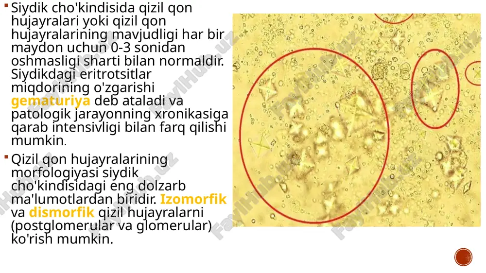 alin tsilindrlari qabul qilinadi. boshqa turdagi tsilindrlar bo'lmasligi kerak  • qo'ziqorinlar va bakteriyalar - to'liq yo'qligi. qo'ziqorinlarni homiladorlik paytida va antibiotiklarni qabul qilgan bemorlarda aniqlash mumkin.  • balg'am oz miqdorda qabul qilinadi.  • tuzlar, ko'p tizimlar faoliyatining ajralmas qismi bo'lsa -da, cho'kindi tarkibida bo'lmasligi kerak. patologik holatlarga shubha qilish uchun indikatorni tahlil qilish:  • gematuriya (qizil qon tanachalarini hisoblash);  • pyuriya (oq qon hujayralari soni);  • silindruriya (silindrlarni hisoblash);  • bakteriuriya (bakteriyalar soni)  • gemoglobinuriya. tuz kristallari, epiteliya hujayralari, shilimshiq, protozoa borligi ham baholanadi. shuni yodda tutish kerakki, ba'zi tashqi omillar siydik cho'kindi mikroskopi tahlilining natijasiga ta'sir qilishi mumkin, masalan:  • haddan tashqari jismoniy faollik;  • dori -darmonlarni qabul qilish (diuretiklar yoki antibiotiklar);  • siydikni yig'ish va etkazib berish qoidalarini buzish;  • parhez. mavzu: siydik cho’kmasi (2) (3) (4) (5) (6) (7)