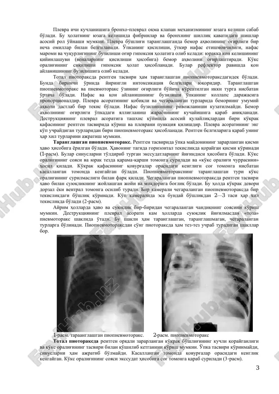 ibati bo'lib, 4—5% bemorlarda aniqlanadi. o'tkir bakterial destruktsiya klinikasi va tashxisi: kasallik ko'p hollarda kataral belgilar bilan o'tkir boshlanadi. tana haroratining ko'tarilishi, hansirash, kataral belgilar o'tkir respirator kasalliklarga, ya'ni bronxit bilan zotiljamga o'xshaydi. lekin shuni bilish kerakki, bolalarning 1/3 qismida kasallikning boshlanishi yashirin sindromlar bilan kuzatiladi, ya'ni abdominal, neyrotoksik, astmoidli va renal. abdominal sindromlar (qayt qilish, qorindagi og'riq, ichaklar parezi, qabziyat) taxminan 15 foiz bolalarda kuzatiladi. neyrotoksikoz 5 foiz bolalarda, 12 foiz bemorlarda har doimgi simptomlaridan biri xurujli yo'tal hisoblanadi, ayrim hollarda astmoid belgilari bo'ladi. yiringlash jarayonining zo'rayishi yoki plevradagi asorat natijasida kuchayib boradigan zaharlanish va nafas buzilishi rivojlanadi. u yoki bu komponentning ko'rinishi kuchayib borishi o'pka va plevraning zararlanish shakliga bog'liq. chaqaloq va emizikli bolalarda zaharlanish va nafas buzilishining tez rivojlanishi darhol bilinadi. o'pka ichi turida ko'p hollarda fizikal belgilar bemor ahvolining og'irligi bilan to'g'ri kelmaydi va bir oz nafas susayishi doimiy bo'lmagan xirillashlarga olib keladi. plevradagi asoratlardan fizikal …