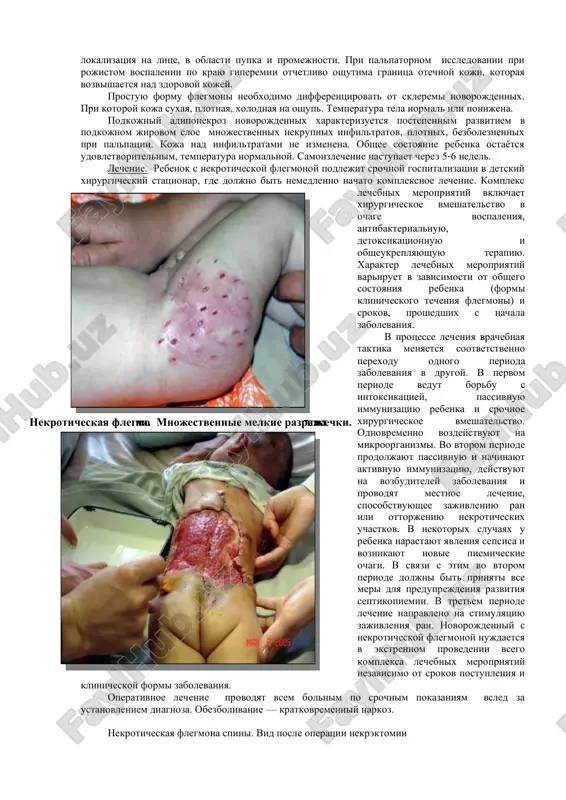 anie rebenka ostayotsya udovletvoritelnim, temperatura normalnoy. samoizlechenie nastupaet cherez 5-6 nedel. lechenie. rebenok s nekroticheskoy flegmonoy podlejit srochnoy gospitalizatsii v detskiy xirurgicheskiy statsionar, gde doljno bit nemedlenno nachato kompleksnoe lechenie. kompleks lechebnix meropriyatiy vklyuchaet xirurgicheskoe vmeshatelstvo v ochage vospaleniya, antibakterialnuyu, detoksikatsionnuyu i obsheukreplyayushuyu terapiyu. xarakter lechebnix meropriyatiy variruet v zavisimosti ot obshego sostoyaniya rebenka (formi klinicheskogo techeniya flegmoni) i srokov, proshedshix s nachala zabolevaniya. v protsesse lecheniya vrachebnaya taktika menyaetsya sootvetstvenno perexodu odnogo perioda zabolevaniya v drugoy. v pervom periode vedut borbu s intoksikatsiey, passivnuyu immunizatsiyu rebenka i srochnoe xirurgicheskoe vmeshatelstvo. odnovremenno vozdeystvuyut na mikroorganizmi. vo vtorom periode prodoljayut passivnuyu i nachinayut aktivnuyu immunizatsiyu, deystvuyut na vozbuditeley zabolevaniya i provodyat mestnoe lechenie, sposobstvuyushee zajivleniyu ran ili ottorjeniyu nekroticheskix uchastkov. v nekotorix sluchayax u rebenka narastayut yavleniya sepsisa i voznikayut novie piemicheskie ochagi. v svyazi s etim vo vtorom periode doljni bit prinyati vse meri dlya preduprejdeniya razvitiya septikopiemii. v tretem …