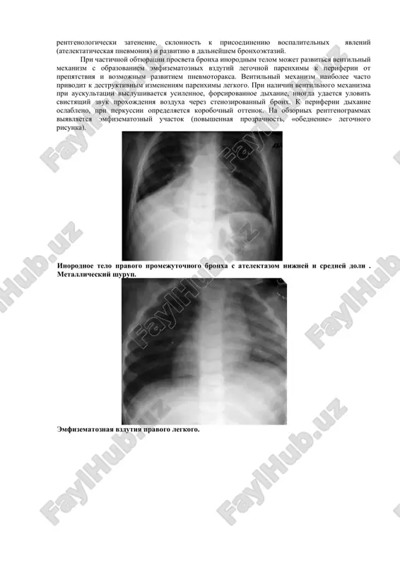 fiksii, ugrojayushey jizni rebenka, opravdana ekstrennaya traxeotomiya. inorodnie tela traxei, tak je kak i inorodnie tela gortani, obichno soprovojdayutsya burnimi klinicheskimi proyavleniyami. ostrie narusheniya dixaniya mogut bit obuslovleni peremesheniem inorodnogo tela reflektornim spazmom golosovoy sheli. xarakteren dlitelniy, pristupoobrazniy, layushiy, muchitelniy kashel, neredko perexodyashiy v rvotu. deti starshego vozrasta inogda otmechayut tupuyu bol za grudinoy. patognomonichnimi priznakami peremesheniya inorodnix tel traxei yavlyayutsya «simptom xlopanya», kotoriy inogda udaetsya vislushivat na rasstoyanii, a takje stridoroznoe dixanie, v redkix sluchayax fiksatsiya v traxee inorodnix tel znachitelnix razmerov s maksimumom stridora v meste lokalizatsii inorodnogo tela. osobogo vnimaniya zaslujivayut inorodnie tela, raspolagayushiesya v oblasti bifurkatsii traxei. smeshayas ili perevorachivayas pri dixanii, oni narushayut ventilyatsiyu to v odnom, to v drugom legkom, chto naxodit otrajenie v peremejayusheysya klinicheskoy kartine – periodi vremennogo blagopoluchiya smenyayutsya pristupami asfiksii i tsianoza. xarakterni menyayushiesya fizikalnie dannie – oslablennoe dixanie s odnoy storoni smenyaetsya oslableniem dixaniya v protivopolojnom legkom. peremejayushiysya ventilniy …