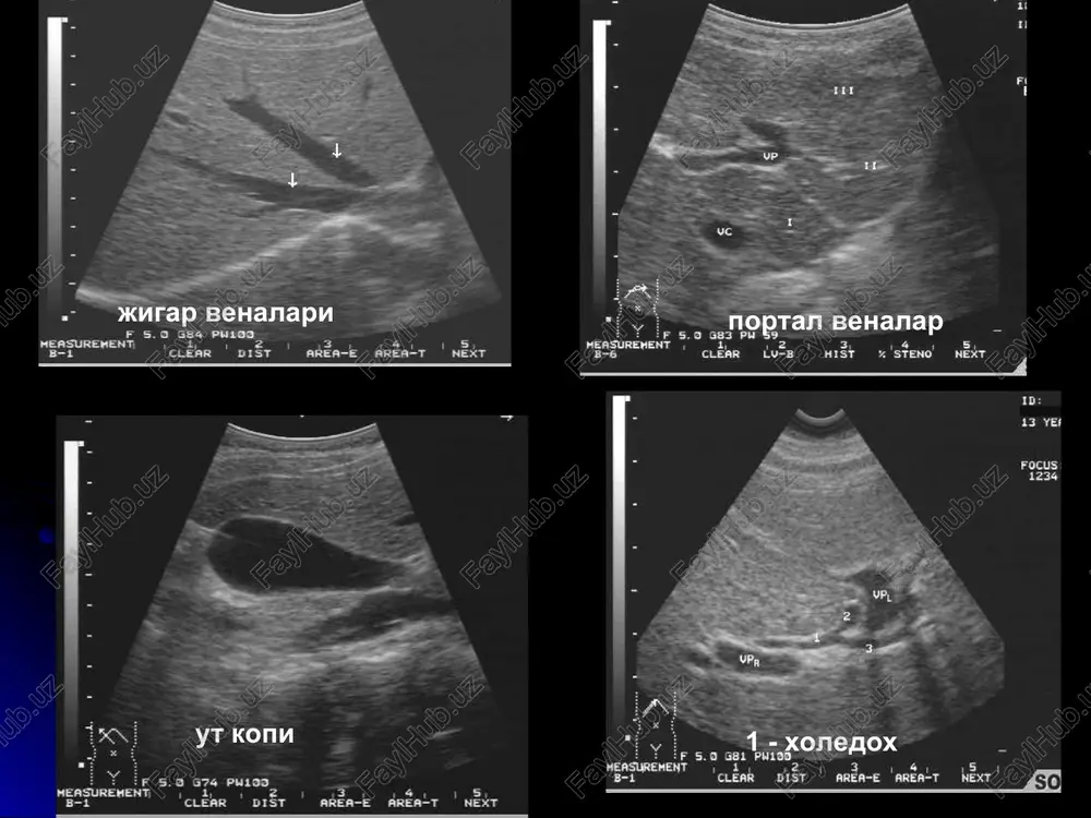 n tomirlar uzgarishi, varikozlarni embolizatsiya, portokaval shunt urnatish. portal gipertenziya splenomegaliya astsit varikoz portal va talok venasi kengayishi portal venada kon sekinlashishi va orkaga kaytishi jigar venasida 1 fazali okim (normada 2 fazali) kt-angiografiya va noinvaziv mr-angiografiya portal gipertenziyada varikoz venalarni yaxshi tasvirlaydi yogli distrofiya diffuz eki uchokli bulishi mumkin gepatomegaliya (80%) sg - «yarkiragan» jigar, ultratovush utishi pasayadi, jigar orkasi va kon-tomirlar yaxshi kurinmaydi kt - jigar zichligi +30n kam (tasdiklaydi!!) jigar funktsiyasi kupincha saklangan jigar kistalari 1) oddiy 2) exinokokk 3) polikistoz sg - 1) yumalok gipoexogen tuzilma 2) chegarasi tekis 3) devori yupka/yuk 4) «tovush yuli» simptomi 5) atrof tukimalar normal kt - 1) zichligi +20n gacha (gipodensiv) kt+kontrast - kontrast yigmaydi 1,3 kuprok aellarda 1,2 ulchami katta bulishi mumkin polikistoz abstsess sg - 1) yumalok, gipoexogen 2) devori kalin 3) suyuklik nogomogen va zichrok kistaga nisbatan 4) ichida gaz 5) atrofida shish+infiltratsiya 6) «tovush yuli» simptomi …