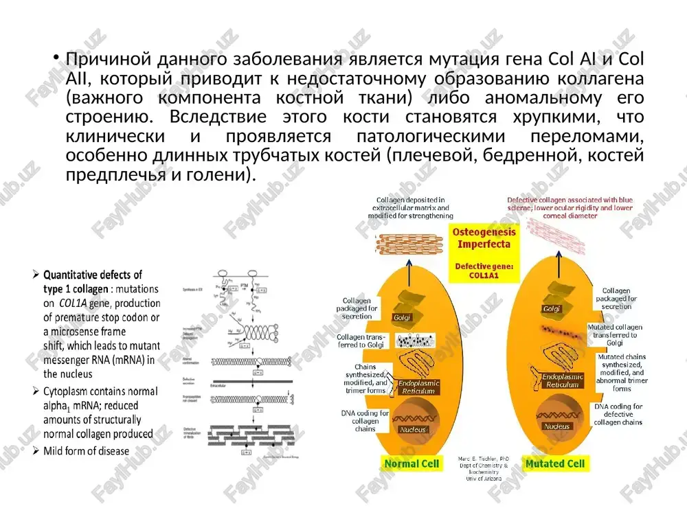 , esli dannim zabolevaniem stradaet xot odin iz ego roditeley. v takom sluchae perelomi chashe voznikayut posle pervogo goda jizni. pri autosomno-retsessivnom tipe nasledovaniya (xarakteren dlya 7 i 8 tipov). bolnimi rojdayutsya te deti, roditeli kotorix imeyut mutatsiyu gena col ai ili col aii. u takix bolnix techenie zabolevaniya bolee tyajeloe: mnojestvennie perelomi voznikayut vo vremya beremennosti materi ili srazu je posle rodov. diagnostika analiz anamneza i jalob zabolevaniya: povishennaya lomkost dlinnix kostey konechnostey s posleduyushim izmeneniem ix formi i ukorocheniem; sero-sinie skleri (belki) glaz; snijenie sluxa vplot do polnoy ego utrati posle 20-30 let. semeyniy anamnez: nalichie zabolevaniya u odnogo iz roditeley ili u dalnix rodstvennikov. diagnostika rentgenologicheskaya kartina zavisit ot tyajesti dannogo zabolevaniya. osnovnim klinicheskim priznakom yavlyaetsya rasprostranenniy osteoporoz (umenshenie plotnosti kosti, sposobstvuyushee snijeniyu ee prochnosti) vsego skeleta. otmechayutsya: znachitelnoe istonchenie narujnogo kompaktnogo sloya dlinnix trubchatix kostey (bedrennoy, plechevoy, predplechya i goleni); umenshenie diametra kosti; patologicheskie perelomi s …