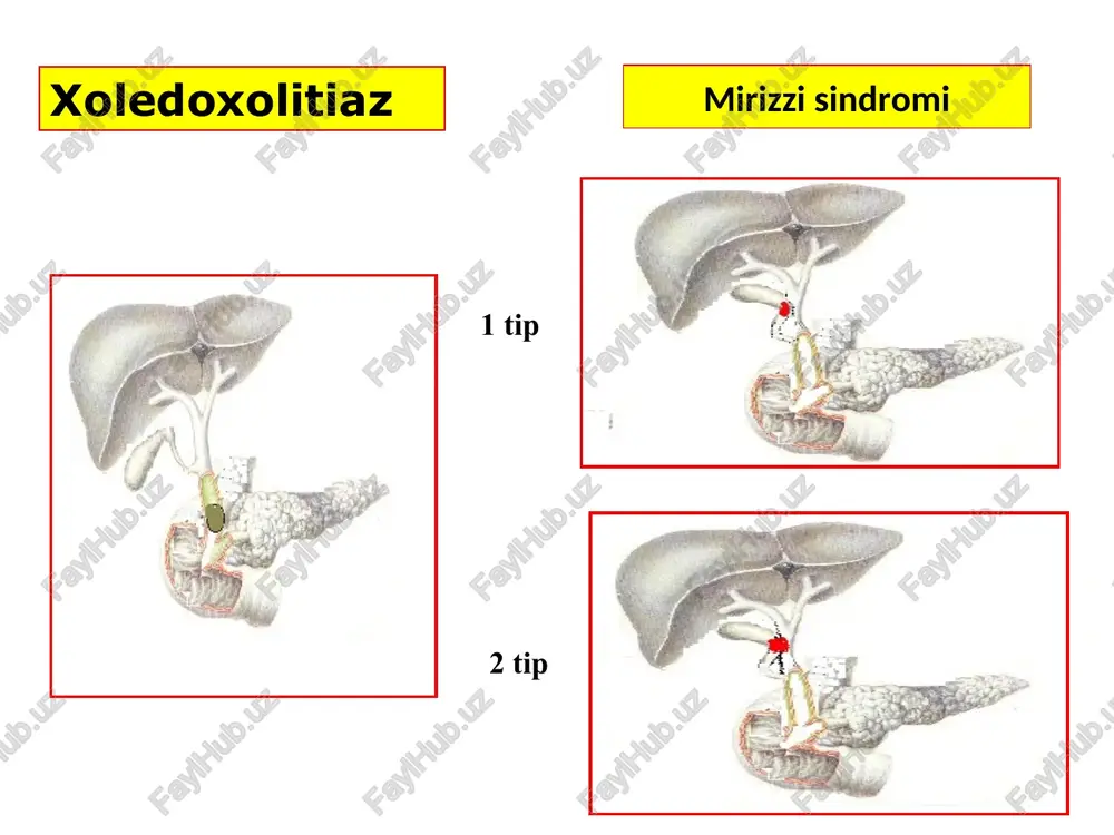 mumkin yoq yoki yoq xolsizlik bor bor yoq ut qopi kattalashgan kattalashmagan kattalashmagan yurak urishi bradikardiya bradikardia normal yoki tahikardia jigar kattalashgan kattalashmagan bir oz kattalashgan taloq kattalashmagan yarim holda kattalashgan kattalashgan mexnik sariqlik bilan bemorlarni davolash algoritmi i bosqich drenajlash dozali dekompressiya poliorgan yetishmovichilikning oldini olish ochiq jarrohlik amaliyotlar ii bosqich ichak ichiga normal o‘t passajini tiklash endoskopik retrograd amaliyotlar teri orqali jigar orqali endobiliar amaliyotlar natija bo‘lmaganda endoskopik retrograd endobiliar amaliyotlarga ko‘rsatma uttda xoledox diametri 8 sm dan ortiq; ms sababi aniqlanganda va patologik o‘zgarish o‘t yo‘lida bo‘lganda uttda o‘t yo‘llarni ko‘rish va farqlash imkoniyati bo‘lmaganda, giperbilirubinemiya kuzatilsa xoledoxolitiaz stenozlovchi papillit xoledox terminal qismini va katta duodenal so‘rg‘ichni 1,5 sm gacha bo‘lgan stenozi i va ii darajali jigar yetishmovchiligi bilan kuzatiladigan mexanik sariqlik qarshi kursatma oik – oui; mqub; uqte; une endoskopik papillosfinkterotomiya amaliyotiga ko‘rsatma kompensatsiya bosqichi jigar bioenergik jarayonlarni yaxshilash (glyukoza eritmasi insulin bilan, vitamin s va …