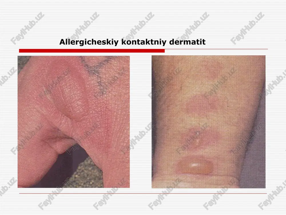 fikasini uzgarishi gushning asosiy turlari chin exema mikrobli seboreyali professional bolalarniki klinik kurinishning utkir bosqichi utkir mikrovezikula eroziya (exematoz quduqchalar) suvlanish kipiqlashish qaloqlar klinik kurinishi surunkali bosqichi turgun eritema simmetriyali joylashgan kupincha kaft va tovonlarda qichishish mikrobli exema assimetriyalashgan chegarasi keskin dumaloq yeki gadir budir uchoq suvlanadi seroz quduqchalar ham yiringchalar bor nummular exema exema seboreyali olib keluvchi faktorlar seboreya ,neyroendokrin uzgarishlar joylashishi : boshning soch qismi ,peshana , quloq orqasi . kurak qafasi .kuraklar orasida .oyeq qullar bukiladigan joyda .giperemiya fonida yeglik sargish qaloqlar ,tangachalar paydo buladi na volosistoy chasti golovi na fone suxoy giperemirovannoy koji voznikaet bolshoe kolichestvo serix otrubevidnix cheshuek, seroznix jeltix korok, posle snyatiya kotorix obnajaetsya moknushaya poverxnost granitsi ochagov chetkie, volosi skleeni bolalar exemasi chin,seboreyali ,mikrobli exemaning alomatlari kuzatiladi . simmetrik chegarasi noaniq teri giperemiyalangan ,shishgan mikrovezikulalar ,quduqchasimon suvlanish ,sargish jigarrang qaloqlar , tangachalar ,tugunchalar professional exema shikastlanadi : kaftlarni yezuvchi soni qullar , yuzi,buyni …