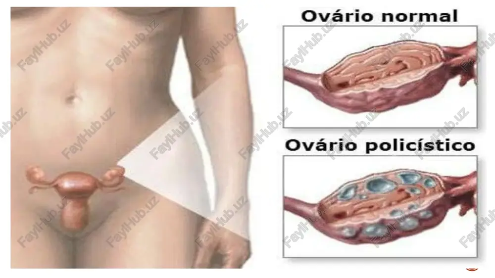 n terapiya usullari reproduktiv yoshdagi ayollarda o’zini to’liq oqlagan. bachadondan tashqari homiladorlik bachadondan tashqari (ektopik) homiladorlik — homiladorlik asoratlaridan biri bo’lib, unda urug’langan tuxum hujayraning implantatsiyasi bachadon bo’shlig’idan tashqarida sodir bo’ladi. kamdan-kam kuzatiladigan istisno holatlardan tashqari, ektopik homiladorlikda homila hayotga layoqatli bo’lmaydi, patologiya esa ko’pincha ichki qon ketish tufayli onaning sog’lig’i uchun xavfli sanaladi.  ektopik homiladorlik shoshilinch tibbiy yordamni talab qiladigan holatlar qatoriga kiradi, tegishli tibbiy yordamsiz bunday buzilish onaning o’limiga olib kelishi mumkin.  tasnifi: a.urug'langan tuxumning joylashishiga ko'ra:  1. qorin bo'shlig'idagi homiladorlik: a) birlamchi, b) ikkilamchi  2. bachadon nayidagi homiladorlik (gr.extra uter tubarria) a) interstitsial qismida joylashishi (9,15%) b) istmik qismida joylashishi (49,6%) v) istmiko-ampulyar qismida joylashishi g) ampulyar qismida joylashishi (40,3%) d) fimbrial qismida joylashishi 3. tuxumdondagi qomiladorlik (gr.ovarialis)  4. bachadondan tashqari homiladorlikning boshqa shakllari: a) bachadon bo'ynida joylashishi b) aralash joylashishi (masalan; tuxumdon - fimbrial qismida joylashishi). v) bachadonning rudimentar shoxlarida joylashishi. …
