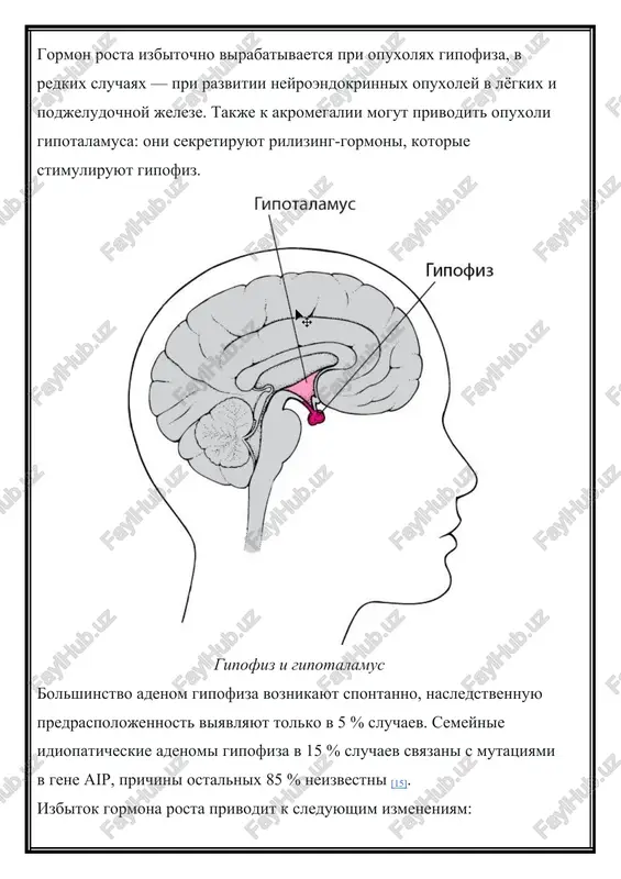u; · somatotropinomi, sostoyashie iz gusto granulirovannix eozinofilnix kletok, — eto opuxoli, kotorie otlichayutsya dobrokachestvennim techeniem i chashe voznikayut u lyudey starshe 50 let; · smeshannie opuxoli — bistro rastut i sdavlivayut okrujayushie tkani; · opuxoli iz atsidofilnix stvolovix kletok — agressivnie obrazovaniya, chashe proyavlyayutsya v 14–18 let; · plyurigormonalnie adenomi i i ii tipa — bistro rastut i sklonni k retsidivam; · atipichnie adenomi, gipofizarnie kartsinomi — bistro rastut, mogut pronikat v okrujayushie tkani [3]. v bolshinstve sluchaev k akromegalii privodyat gormonalno-aktivnie dobrokachestvennie opuxoli gipofiza [16]. stepeni tyajesti akromegalii v zavisimosti ot sostoyaniya bolnogo videlyayut tri stepeni tyajesti akromegalii: · lyogkaya — patsient umerenno aktiven, preobladayut nespetsificheskie simptomi: mishechnaya slabost, utomlyaemost i golovnaya bol. zabolevanie lechitsya v ambulatornix usloviyax. · srednyaya — patsient obslujivaet sebya samostoyatelno, no rabotat uje ne mojet. bolezn proyavlyaetsya odishkoy i gipertoniey, u cheloveka povrejdayutsya sustavi, chto ogranichivaet ego podvijnost. na etoy stadii akromegaliya toje …