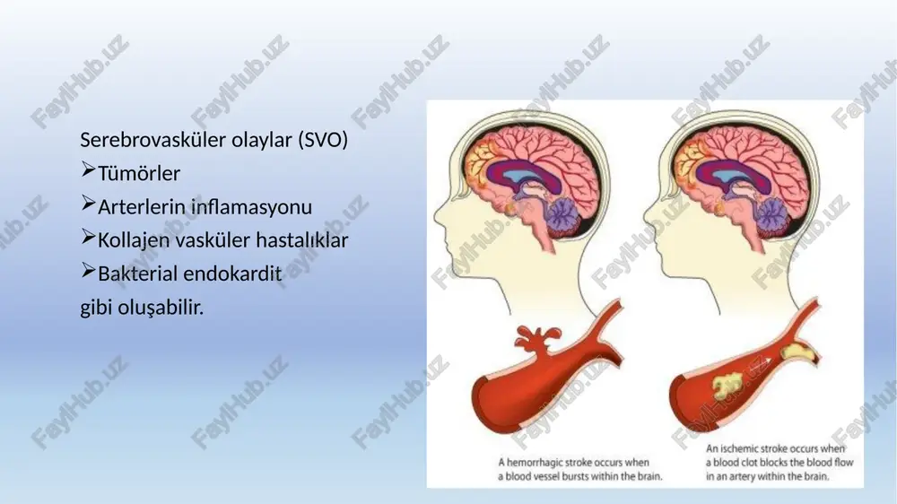 ular karoti̇d ve vertebral arterler beynin sulanmasını sağlar. karotid arter sistemi beynin ön bölgelerini sular (anterior dolaşım) vertebral arterler beynin arka tarafı ve beyin sapını sular (posterior dolaşım) anteri̇or dolaşim svo'ların büyük çoğunluğu (%80) karotid sistemde serebral hemisferleri etkileyerek hemiparaziye neden olur. hemiparazinin şiddeti değişkenlik gösterir. posteri̇or dolaşim beyin sapı tutulumunda genellikle bilateral bulgular kranial ve serebellar bulgular ön plandadır. afazi (dominant lob) ve monoküler körlük karotid tutulumunu yansıtır. anteri̇or dolaşim i̇skemi̇si̇ sonucu ortaya çikan kli̇ni̇k bulgular posteri̇or dolaşim i̇skemi̇si̇ sonucu ortaya çikan kli̇ni̇k bulgular bulgu frekans bulgu frekans hemiparazi %65 ataksi %50 hemianestezi %60 bilateral veya hemianestezi %30 monoküler körlük %35 vertigo %30 fasial uyuşukluk %30 hemiparazi %25 alt fasial zayıflık %25 dizartri, disfaji %25 afazi %20 senkop veya başdönmesi %25 başağrısı %20 başağrısı %20 dizartri %15 kulak çınlaması %10 görme alanı kaybı %15 diplopi %10 vasküler lezyonlarin yeri̇ne göre kli̇ni̇k bulgular orta serebral arter kontralateral hemipleji (üst ekst. …
