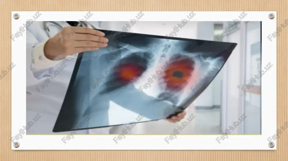 logik kasalliklar ichida eng ko‘p uchraydigan turlari – o‘pka, sut bezi, to‘g‘ri va ko‘ndalang chambar ichak, me’da, teri, jigar va prostata bezi saratonlaridir. klinik belgilari. oxirgi yillarda tuxumdon, sut bezi, og‘iz bo‘shlig‘i a’zolari, bosh miya, buyrak, siydik qopi o‘smalarining ko‘payishi kuzatilmoqda. bolalarda xavfli o‘sma kasalliklari 2,5-3 foizni (umumiy kasalliklar strukturasida) tashkil qiladi. onkologik kasalliklarni barvaqt bosqichlarda aniqlash imkoniyati haligacha yaratilmagan, bu esa o‘lim ko‘rsatkichi o‘sishiga olib kelmoqda. kasallikni erta aniqlashda uning dastlabki belgilari (simptomlari)ga e’tibor berish kerak. kasallik rivojlanishida klinik belgilar muhim axamiyatga ega. o‘sma jarayoni uzoq yillar rivojlanishini inobatga oladigan bo‘lsak, (10-20 yilgacha) va u 80 foiz bemorning to‘qimalarida o‘smaoldi o‘zgarishi yoki o‘smaoldi kasalliklaridan keyin rivojlanishi mumkin. shuning uchun o‘sma kasalliklarining o‘ziga xos belgilari kuzatilmaydi, bo‘lsa ham uni ilg‘ab olish qiyin. bundan tashqari, har bir a’zoning o‘ziga yarasha o‘smaoldi kasaliklari mavjud bo‘lib, ma’lum bir klinik ko‘rinishga egadir. xavfli o’smalarning klinik belgilari. xavfli o‘sma rivojlanishi uzoq davom etadigan jarayon bo‘lib, …