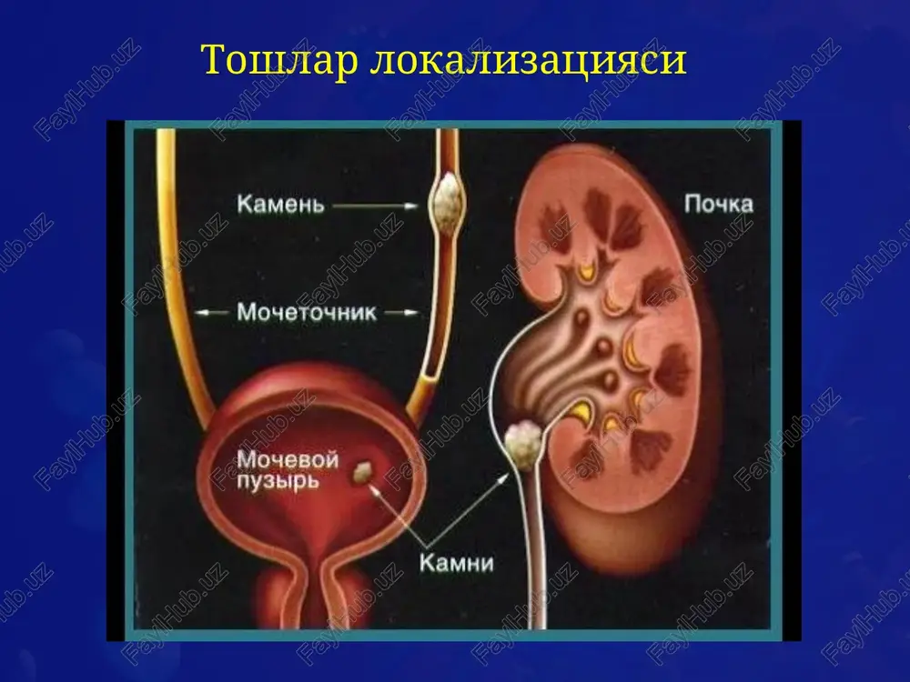 medikamentlarni kullash mumkin : diklofenak natriy indometatsin gidromorfon gidroxlorid + atropin sulfat metamizol (methamizol) pentazotsin tramadol toshlarni olib tashlash umumiy tavsiyalar toshlar jarroxlik yuli bilan olish rejalashtirilgan bemorlarga: infektsiya bor-yukligini aniklash (siydik bak.ekmasi bilan). yuragida sun'iy peysmekeri bor bemorlarga kardiolog kurigi tavsiya kilinadi. kon ivishining buzilishi bilan kechadigan kasalliklari borligini, xamda bemorlarni antikoagulyant kabul kilish-kilmasligi xisobga olinishi zarur. koagulopatiyasi bor bemorlarda kuyidagi turdagi operatsiyalarni bajarish mumkin emas: ekstrakorporal zarba-tulkinli litotripsiya (eztl). pk nefrolitotomiya (litotripsiya bilan yoki litotripsiyasiz). ureteroskopiya (urs). ochik an'anaviy operatsiyalar. umumiy tavsiyalar: xomiladorlarga karshi kursatma bulib xisoblanadi: ekstrakorporal zarba-tulkinli litotripsiya (eztl-euvl) pk nefrolitotomiya (litotripsiya bilan yoki litotripsiyasiz rnl) ureteroskopiya (urs) bunday ayollarga drenajlash operatsiyalari bajarilgani ma'kul: pk nefrostomiya dabl- j stent urnatish siydik nayini kateterlash toshni olib tashlashga kursatmalar: toshning ulchami, lokalizatsiyasi va shaklidan kelib chikkan xolda uni olib tashlash taktikasi xal kilinadi. toshni mustakil xolda siydik yullaridan chikib ketishi extimolini xisobga olish kerak (tosh ulchami 4 mm …