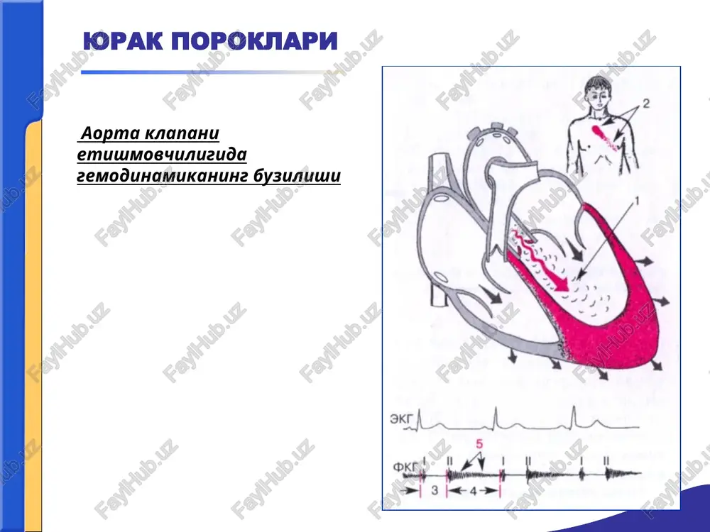 y t tishchalari tez-tez uchraydi. rentgenologik tekshiruv – yurakda hosil bo'lgan aortal konfugratsiya natijasida chap qorincha hajmining kengayishi kuzatiladi. chap qorincha dilyatatsiyasining gipertrofiyasi mavjudligi bilan bog'liq holda yurak uchining yumaloqlashishi aniqlanadi. porok etiologiyasi sifilis bilan bog'liq bo'lgan holda aortaning pastki qismi kengaygan bo'ladi. aortal teshik stenozi (ats) yurak chap qorinchasi qisqarganda aortaga qon oqishiga qarshiliklar yuzaga keladigan xollardagi porok (aortal klapan yoriqlarining bitishi yoki aorta ogzidagi chandiqlar qisqarishi) sabablari: -revmatik endokardit -bakterial endokardit -ateroskleroz -tug'ma poroklar yurak poroklari aorta teshigi stenozida gemodinamikaning buzilishi aorta teshigi stenozi simptomatologiya si shikoyatlar: -stenokardiya tipida yurak soxasidagi og'riqlar. -bosh aylanishlar, -bosh og'riqlar, -bexushlikka moyillik. ko'zdan kechirish: -teri rangining okarishi -yurak uchi turtkisini chap tomonga, ba'zan pastga ko'chgan kuchli silkinishda namoen bulishi paypaslash(palpatsiya) -yurak uchi turtkisini chap tomonga, ba'zan pastga ko'chgan kuchli silkinishi. - aorta ustida sistolik «mushuk xirillashi» yuzaga keladi. yurak poroklari tukillatish (perkussiya) tukillatishda yurakning bo'g'iq ovozi chap qorinchaning kengayishi hisobiga chap tomonga …