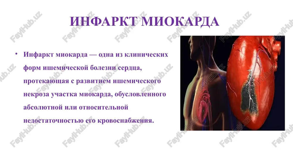 threads of fibrin and activated platelets patofiziologiya pri im sokratitelnaya funktsiya miokarda zavisit ot ploshadi povrejdennogo uchastka serdtsa, tak narushenie etoy funktsii proyavlyaetsya gipokineziey, akineziey ili diskineziey (parodaksalnoe vipyachivanie chasti infarkta vo vremya sistoli). chem bolshe uchastok povrejden tem menshe nasosnaya funktsiya lj: esli sokratimost lj snijaetsya bolee 10% , to snijaetsya fv (fraktsiya vibrosa). esli previshaet 15% - to povishaetsya poslednee diastolicheskoe davlenie i ob'em lj. esli previshaet 25% - proixodit otyok legkogo esli previshaet 40% voznikaet kardiogenniy shok. umenshenie zoni povrejdeniya uluchshaet patofiziologicheskoe i klinicheskoe sostoyanie bolnogo. klassifikatsiya infarkta miokarda i. po velichine i glubine porajeniya serdechnoy mishtsi (po dannim ekg): transmuralniy (s zubtsom q): - s pod'emom segmenta st v pervie chasi zabolevaniya i formirovaniem zubtsa q v posleduyushem. ekvivalenti zubtsa q – izmeneniya amplitudi zubtsa r netransmuralniy (bez zubtsa q) : intramuralniy - im s pod'emom segmenta s-t protekaet blagopriyatno, no s visokoy veroyatnostyu retsidiva, pokazano …