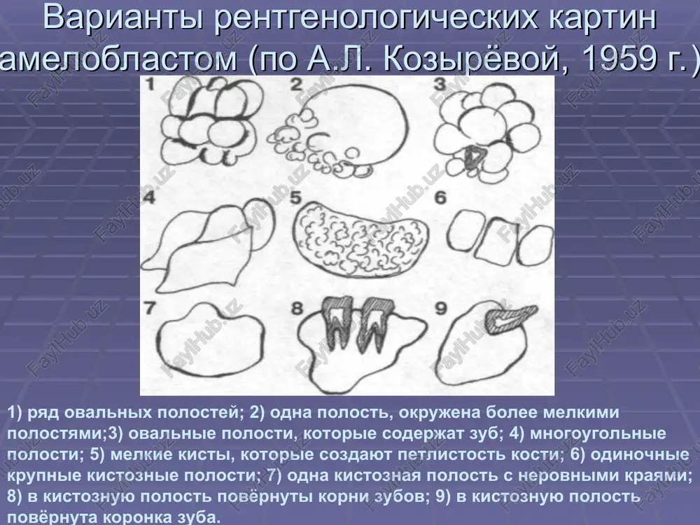 nnie rozrostaniya na verxney chelyusti. greben zubnogo ryada sovpadaet s promejutkom mejdu valikami tkani. epulis (vospalitelnaya fibroznaya giperplaziya). vidno plotnuyu kollagenovuyu soedinitelnuyu tkan. epulis (vospalitelnaya fibroznaya giperplaziya). mikrofotografiya demonstriruet fibroznuyu giperplaziyu s zametnoy fissuroy. vrojdyonniy epulis novorojdyonnogo. epulis na alveolyarnom otrostke nijney chelyusti. fibromatozniy epulis. op? " | @paruenr onyxonn nopaxapunni xpsinosatoe 1 apaibapenruanshioe npocrparicrao