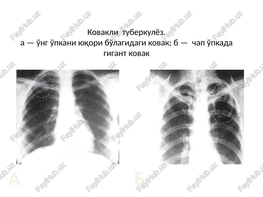 pacteop 1 mn bhytpumbimedho | 18-364acos | ycunneaet (buxacon) 0,015 r. 2-3 pasa bhytpb ogpasosanue tpom6una 8 nesehn avuynion 12,5% pactsop 2-4 mn 5-15 mn @opmmposanne bhytpmbehho mmm bhytphmbiweyho 1-2 4aca tpomgonnactuha ©vgpunores | 250-500 mn bhytphbehho kanenbho 30 mn yexopaer nepexon cbu6punorena cbu6pun tpomgouuthan | 125 mn bhytpmbehho kanenbho, 5-10 maw tipu macca : i tpomountonennn ao kype 6-8 tpanedyauit 20x10? n menee femocbo6un 1 cr. noxka 3 pasa 3-64acon | yckopaet nepexog 0,5 vaca ebupunorena g 5 mn bhytpumbiwie4ho cbnopun ochobhble npenapattbi 3amectuteenbhon tepanunu uv ux ao3upobka npenapat dlo3za kpathoctb bbefehuaa sputpountaphaa macca mo 150 mn u/aeh» 4-6 tpancebyanit mnasma mo 150-200 mn 2-3 tpanedby3un kohcepbupobahhaa npoteun no 250 mn 1-2 tpanceysun anb6ymun 20% - 50 mn ton kontponem 10% - 100 mn npotewhorpammbi 5% - 250 mn nonurntoknn (penonurntokun) ponpekc qo 400-1.200 mn ochobhbie npenapatbi 3amectuteenbhon tepanun u ux bao3supobka npenapat o3a kpathoctb bbefehua kenatuhonb do 500 …